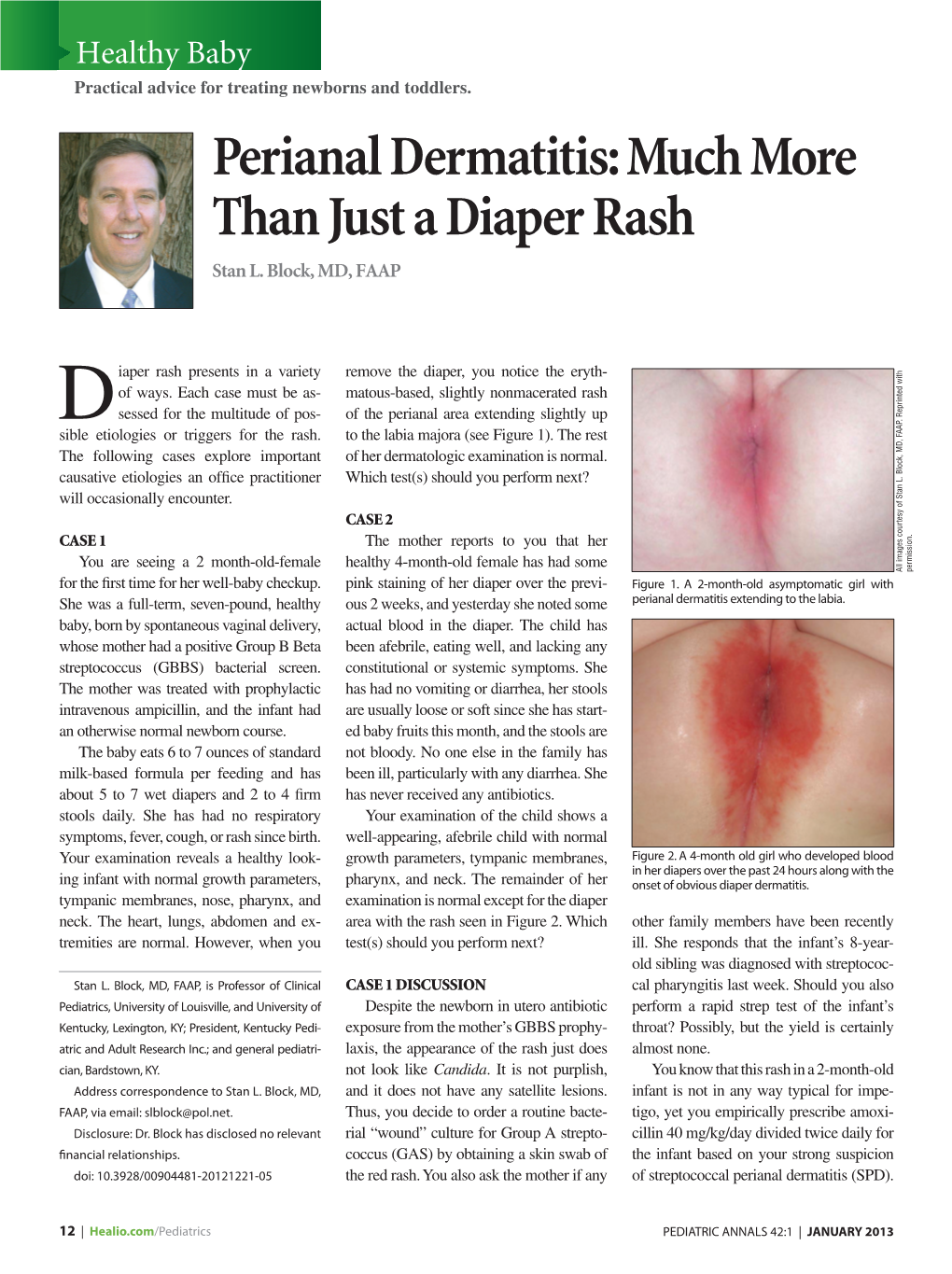 Perianal Dermatitis: Much More Than Just a Diaper Rash Stan L