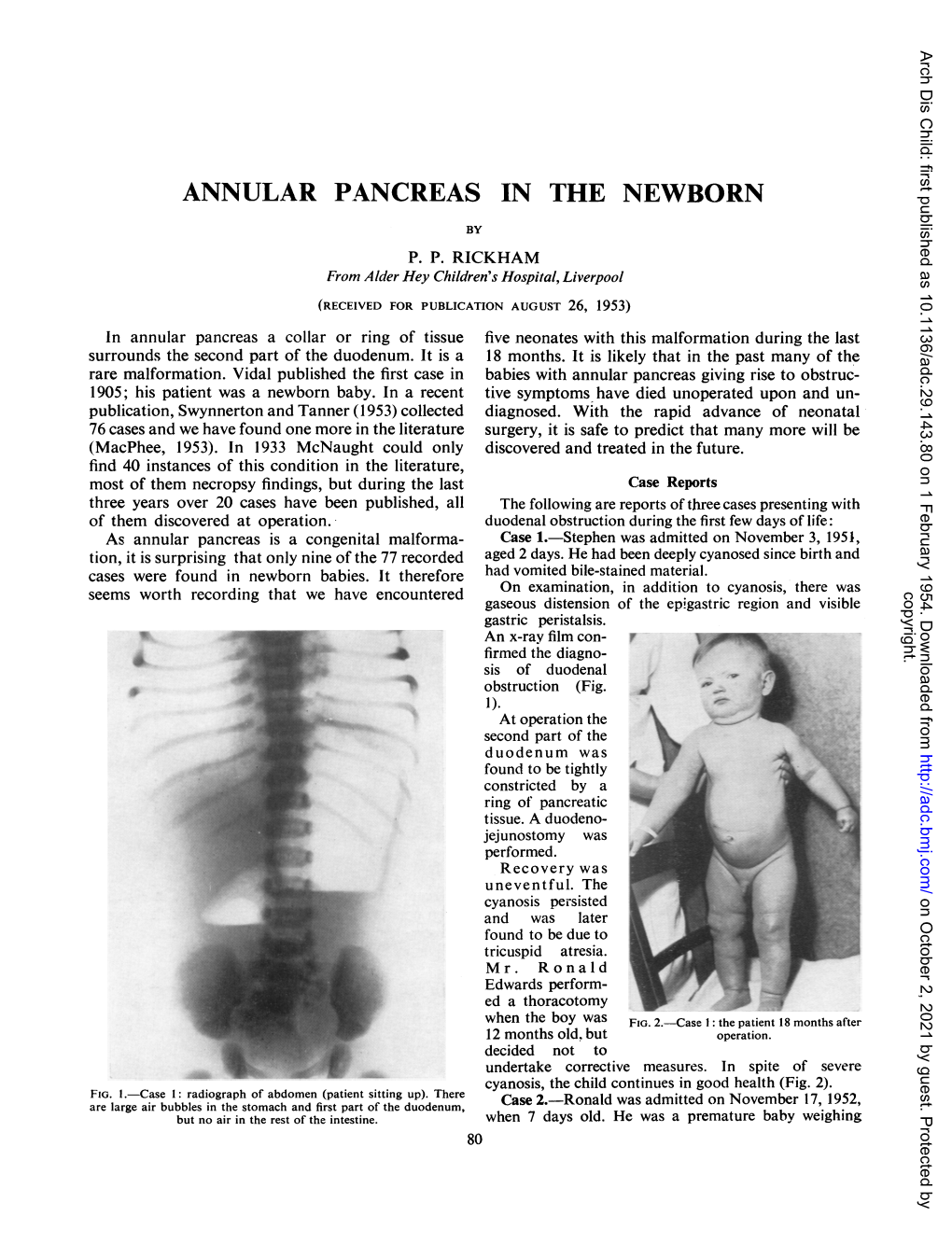 Annular Pancreas in the Newborn