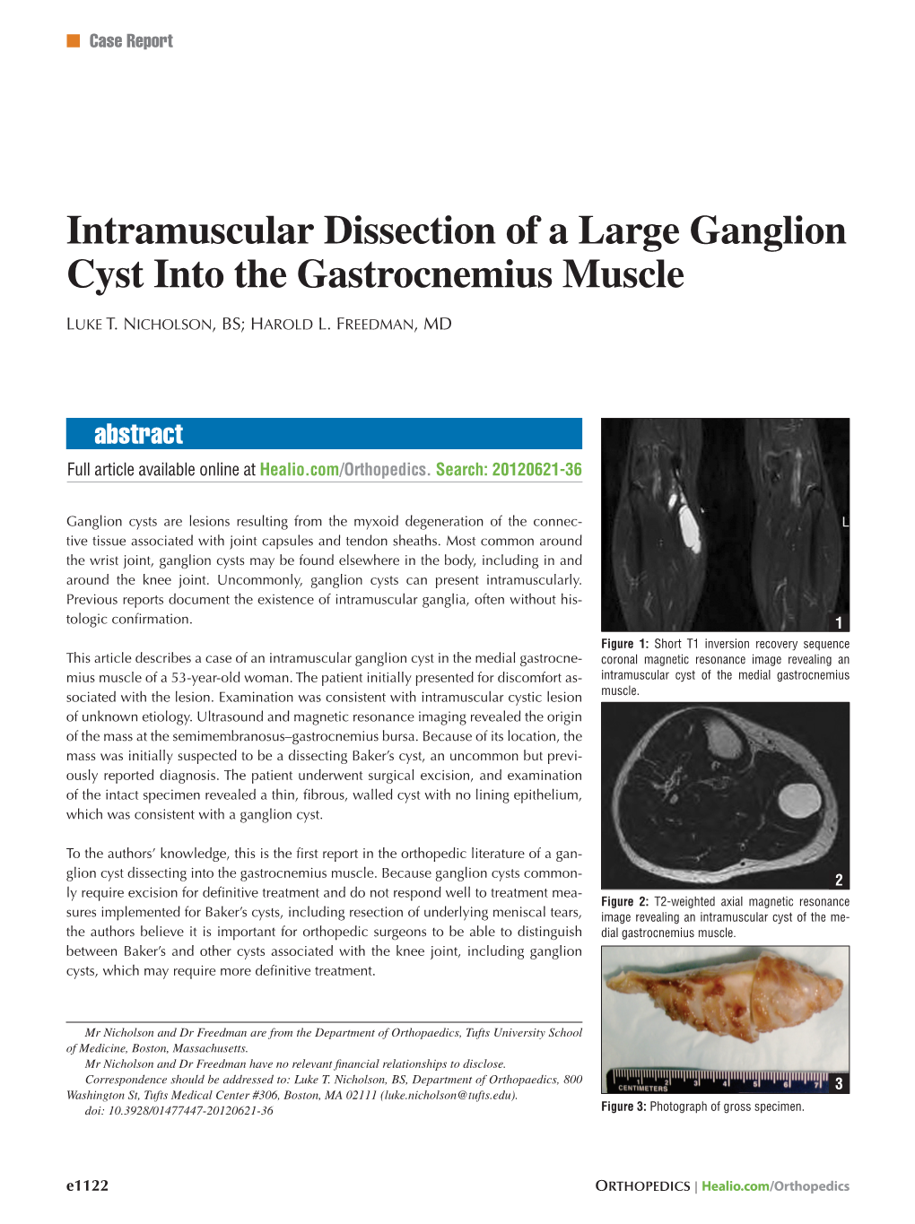 Intramuscular Dissection of a Large Ganglion Cyst Into the Gastrocnemius Muscle