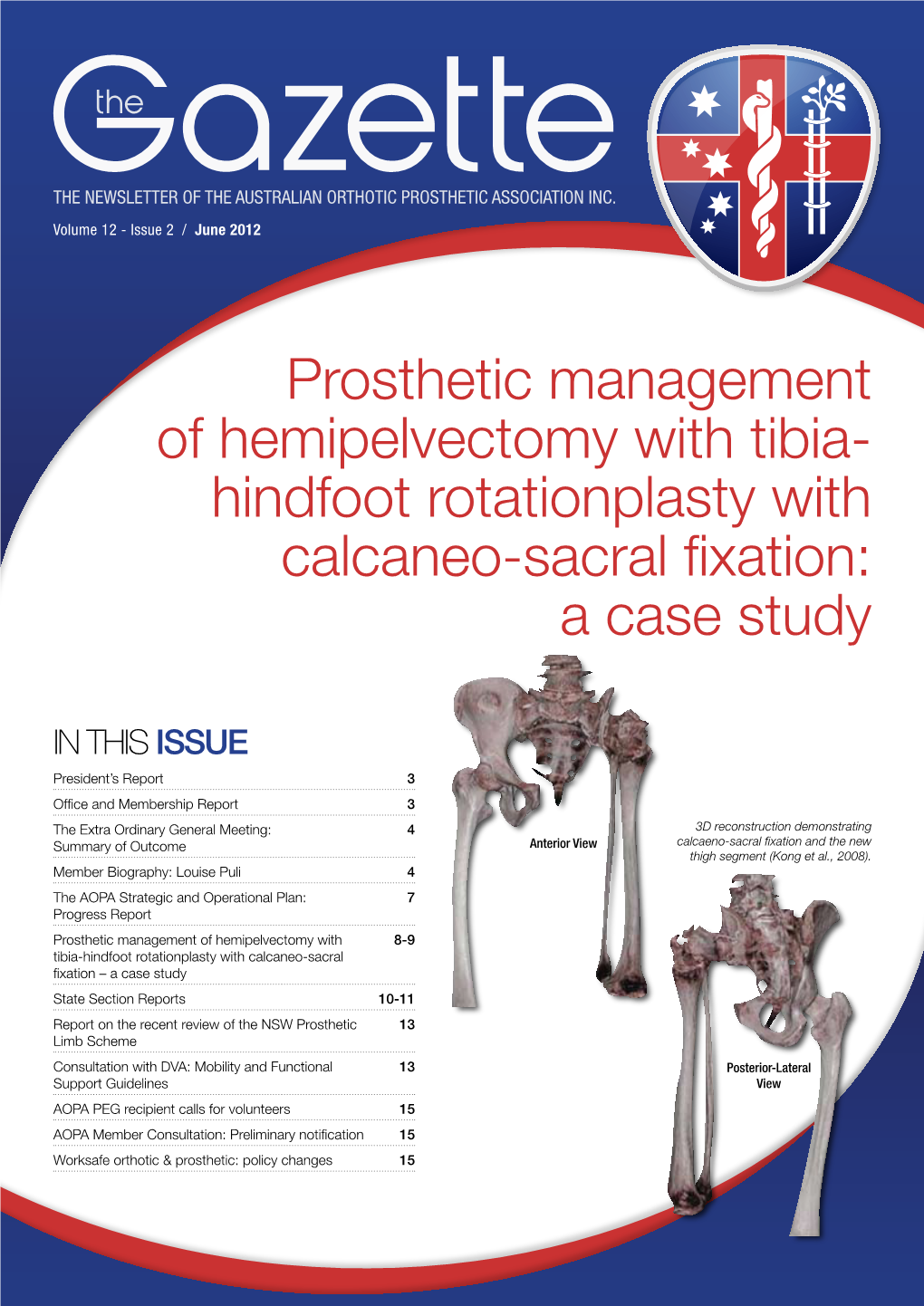 Hindfoot Rotationplasty with Calcaneo-Sacral Fixation: a Case Study