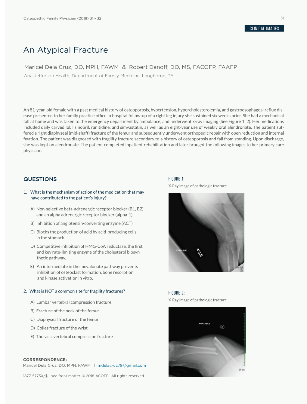 An Atypical Fracture