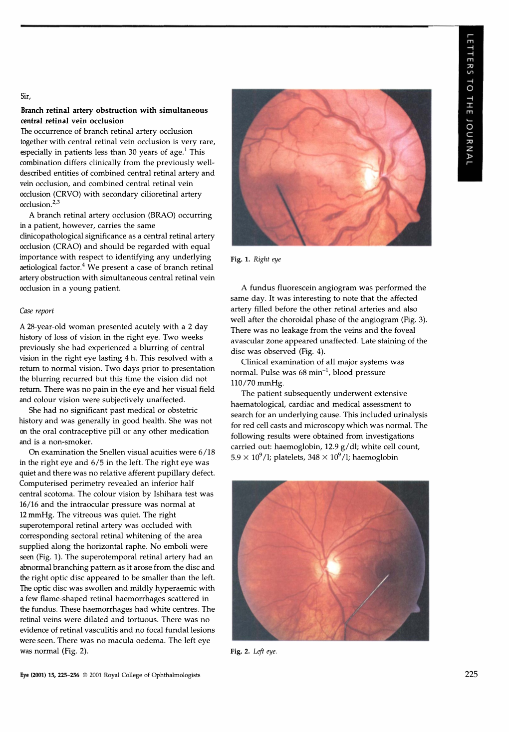 Sir, the Occurrence of Branch Retinal Artery Occlusion Together With