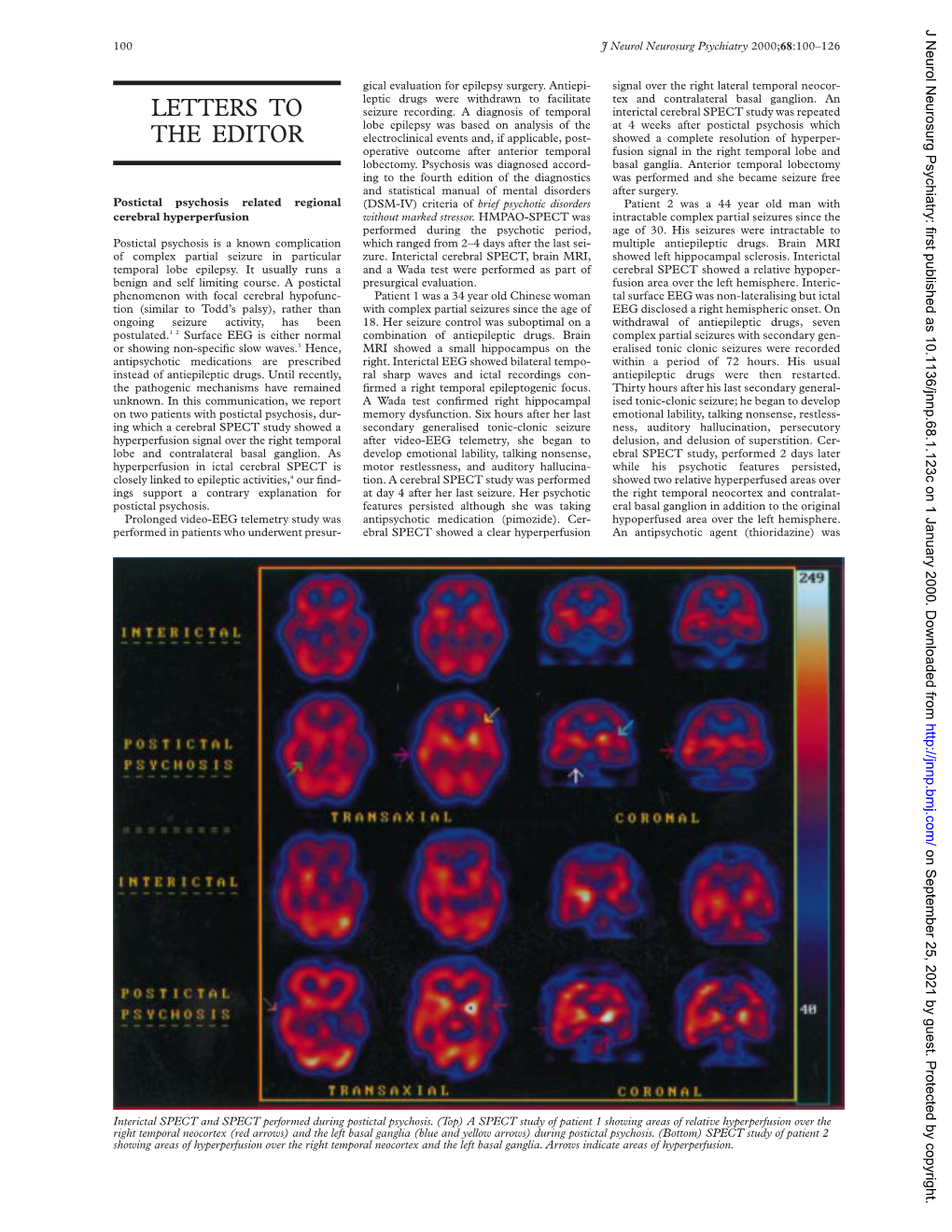 Stroke and Alzheimer's Disease