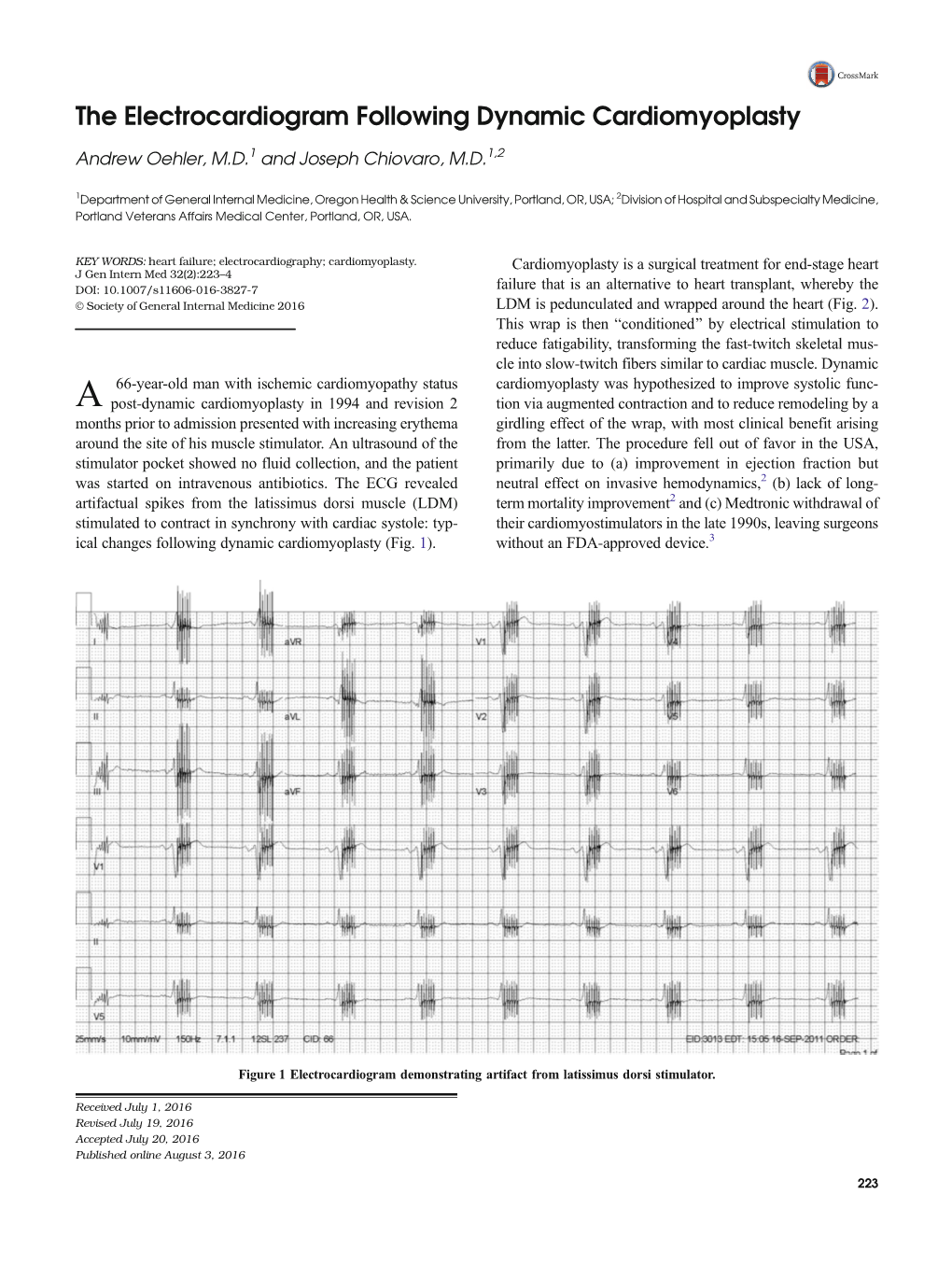 The Electrocardiogram Following Dynamic Cardiomyoplasty Andrew Oehler, M.D.1 and Joseph Chiovaro, M.D.1,2