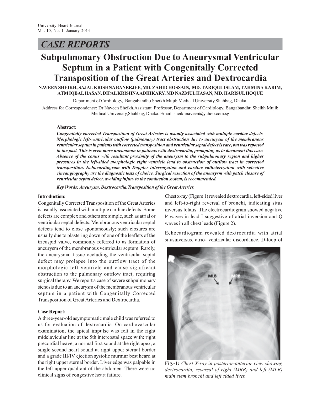 Subpulmonary Obstruction Due to Aneurysmal Ventricular Septum in A