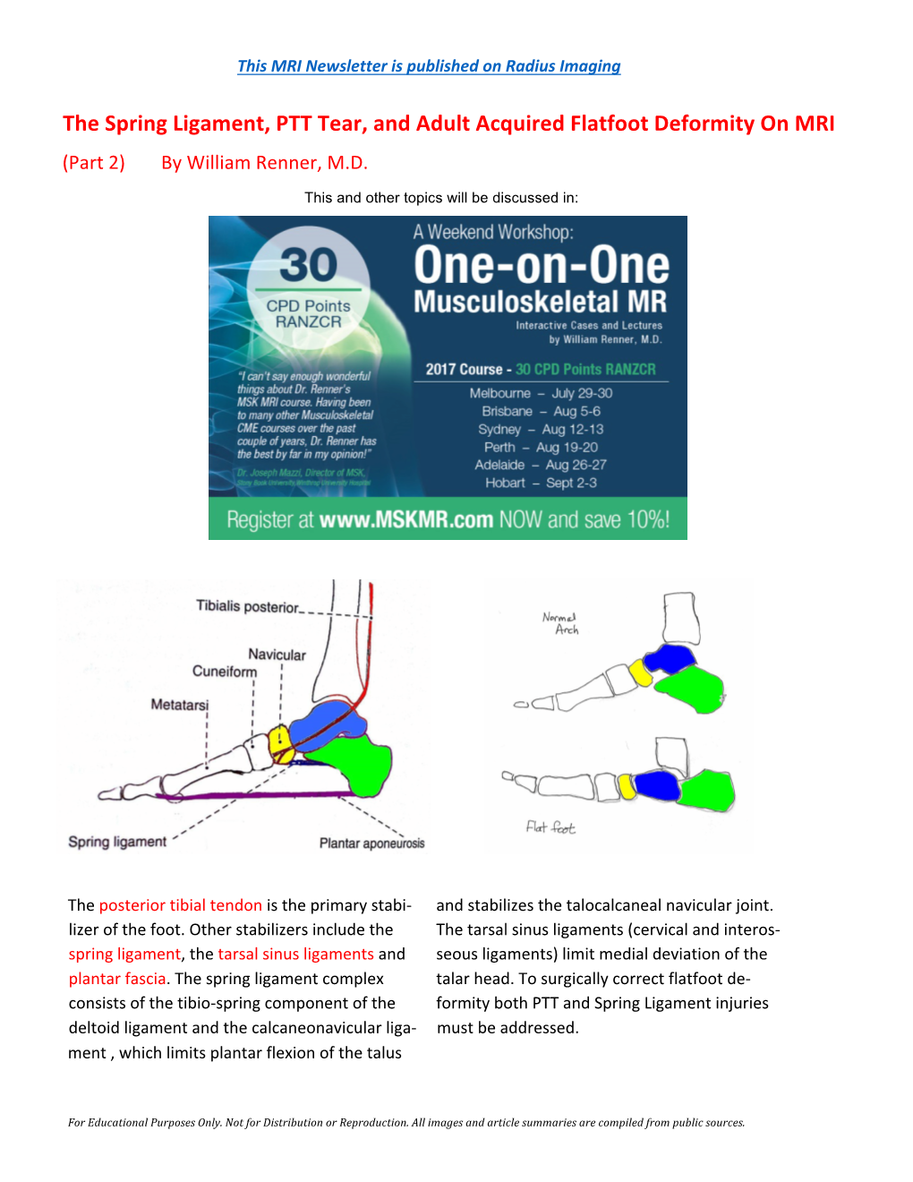 The Spring Ligament, PTT Tear, and Adult Acquired Flatfoot Deformity on MRI (Part 2) by William Renner, M.D