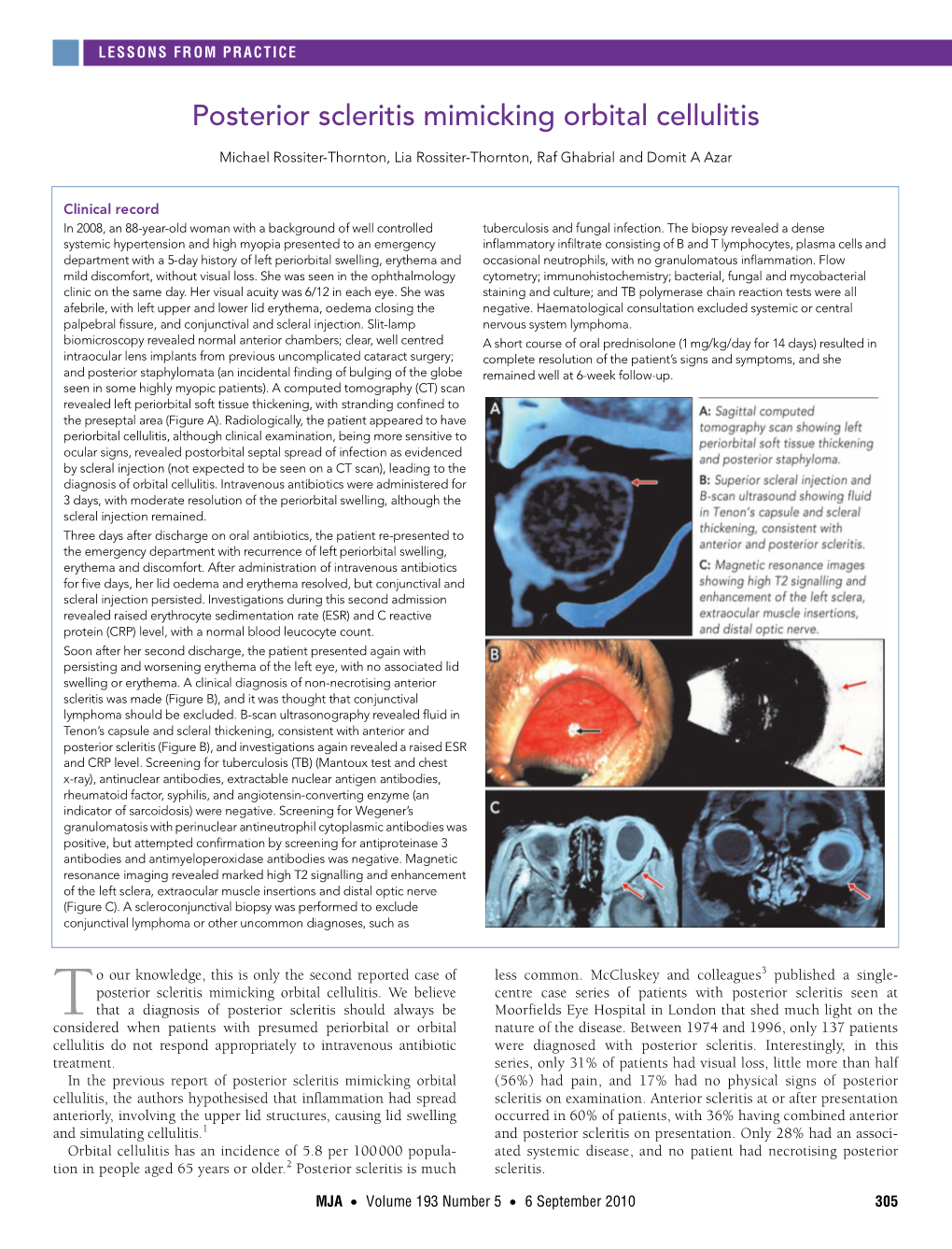 Posterior Scleritis Mimicking Orbital Cellulitis