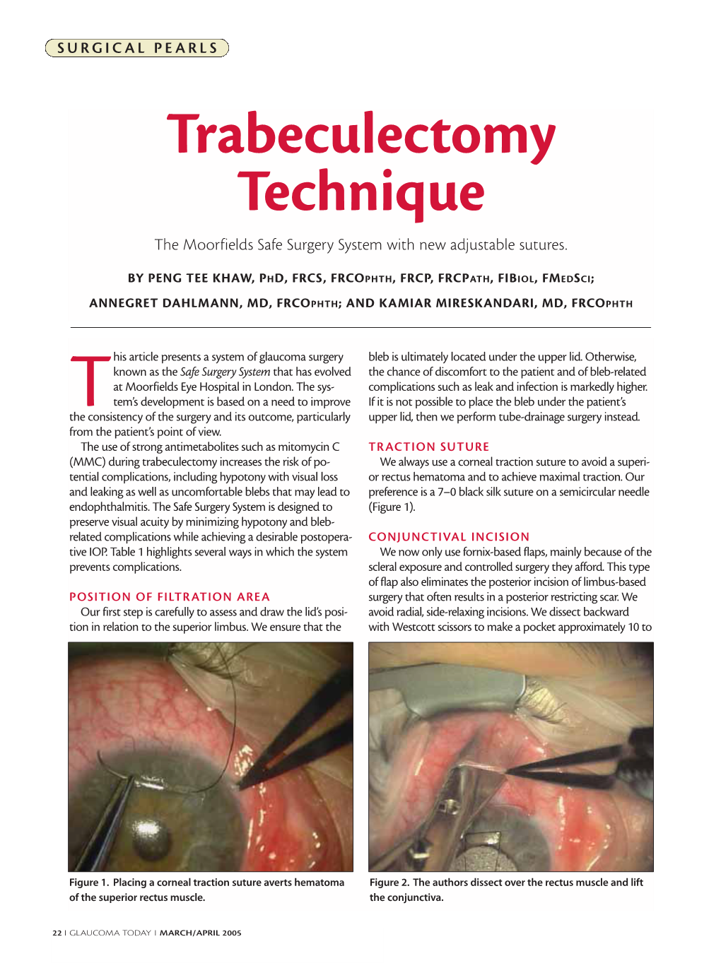 Trabeculectomy Technique the Moorfields Safe Surgery System with New Adjustable Sutures