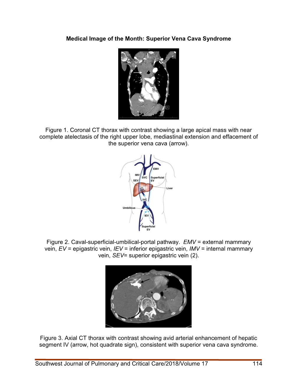 Southwest Journal of Pulmonary and Critical Care/2018/Volume 17 114 Medical Image of the Month: Superior Vena Cava Syndrome Figu