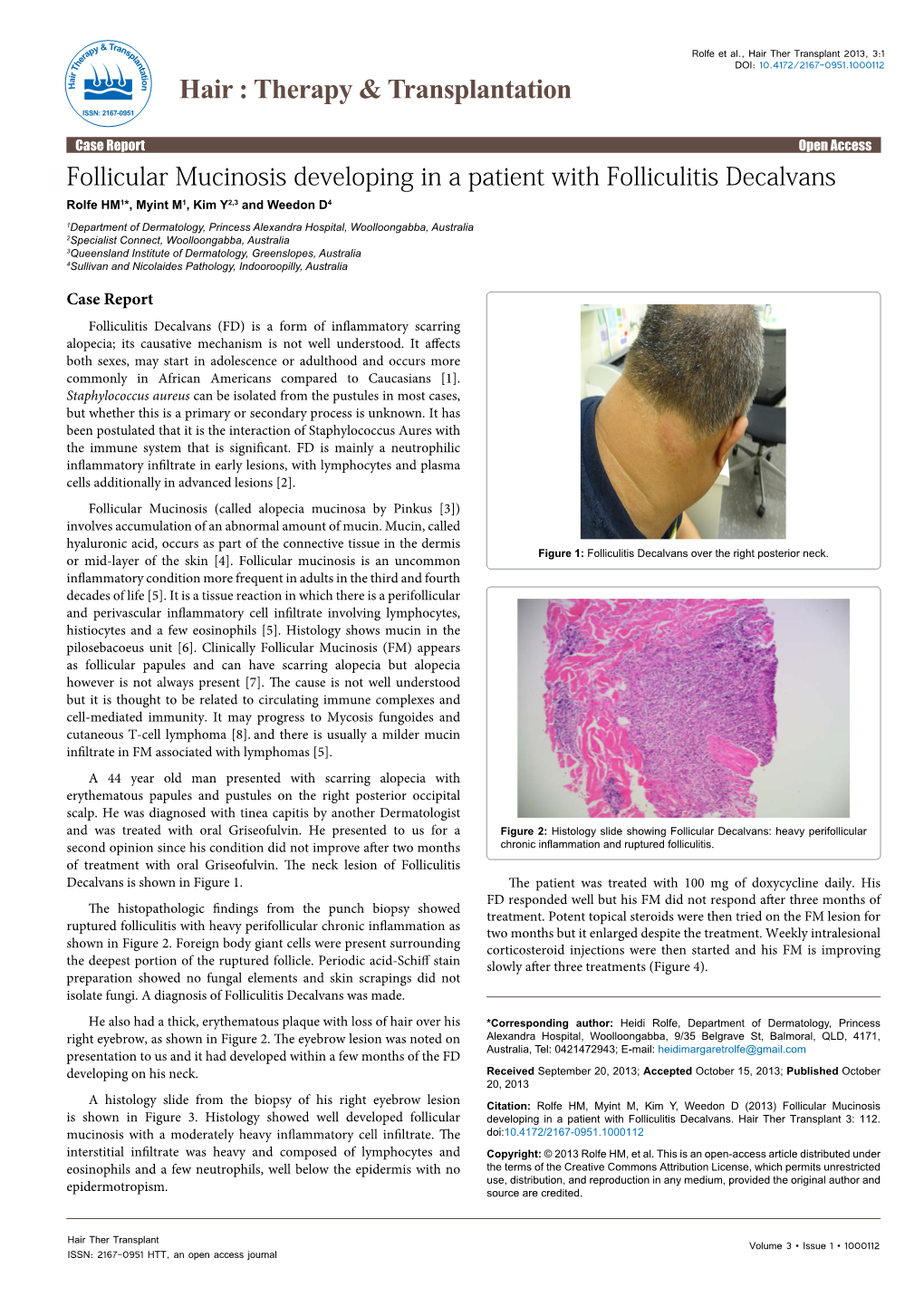 Follicular Mucinosis Developing in a Patient with Folliculitis Decalvans