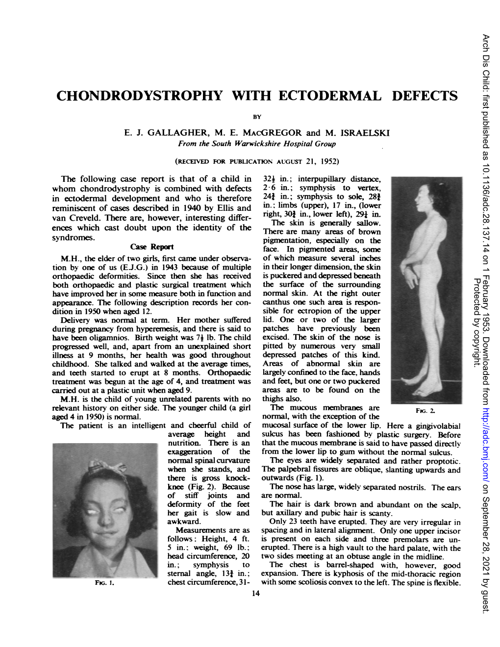 Chondrodystrophy with Ectodermal Defects