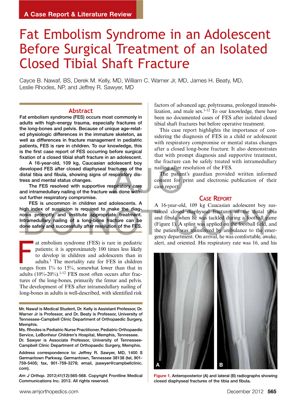 Fat Embolism Syndrome in an Adolescent Before Surgical Treatment of an Isolated Closed Tibial Shaft Fracture
