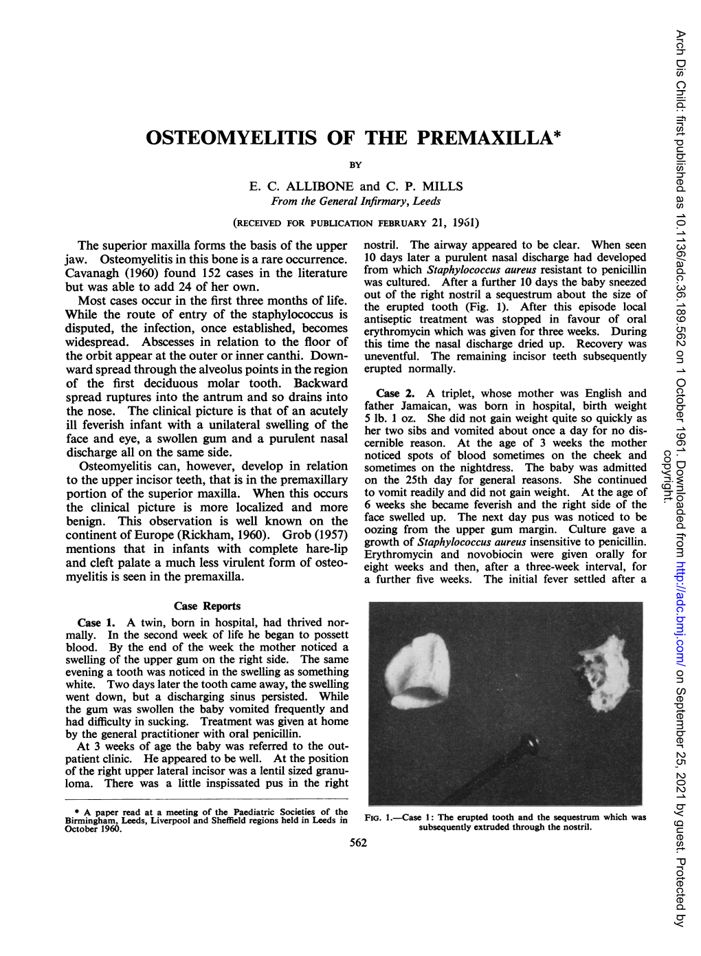 Osteomyelitis of the Premaxilla* by E