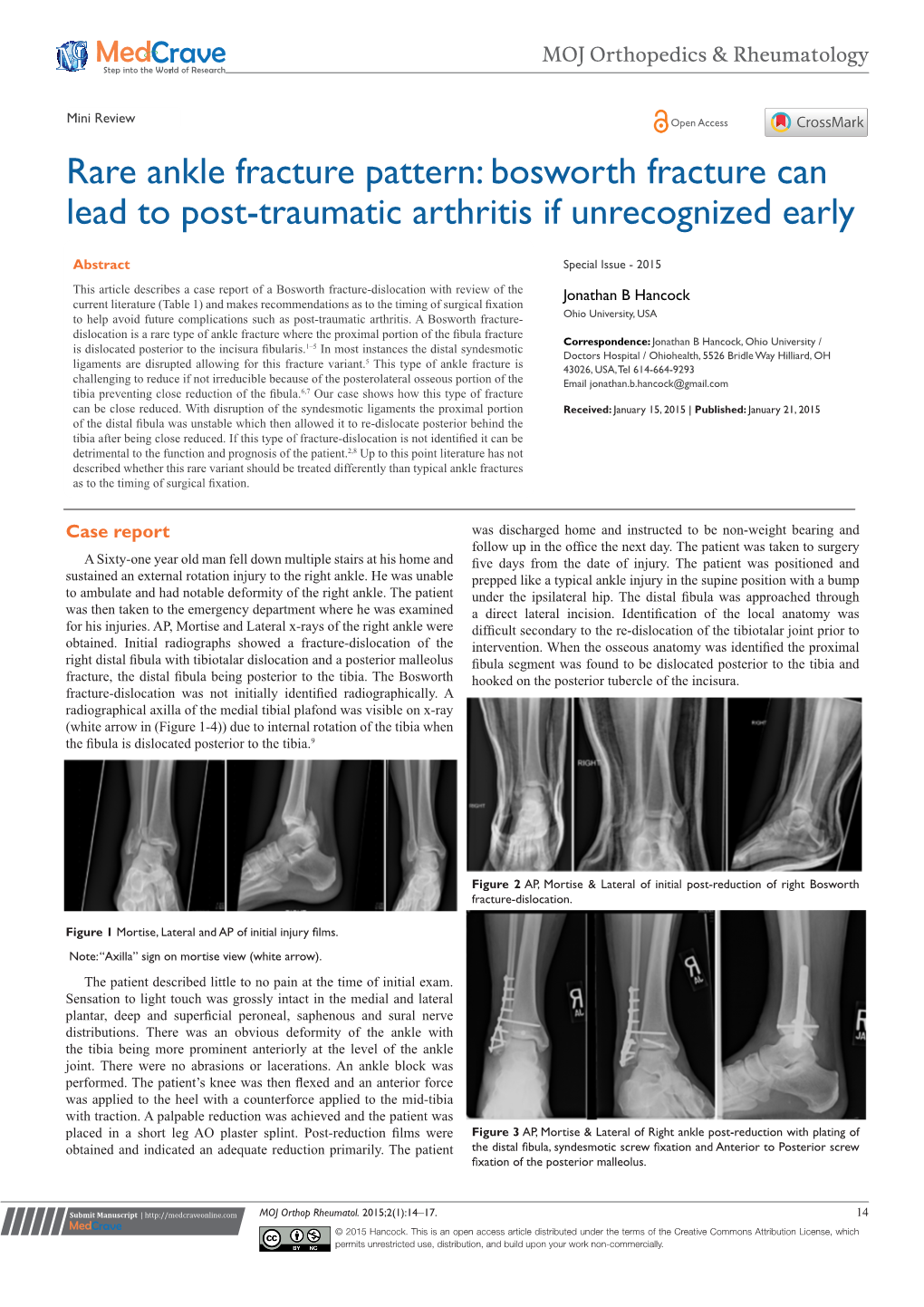 Rare Ankle Fracture Pattern: Bosworth Fracture Can Lead to Post-Traumatic Arthritis If Unrecognized Early