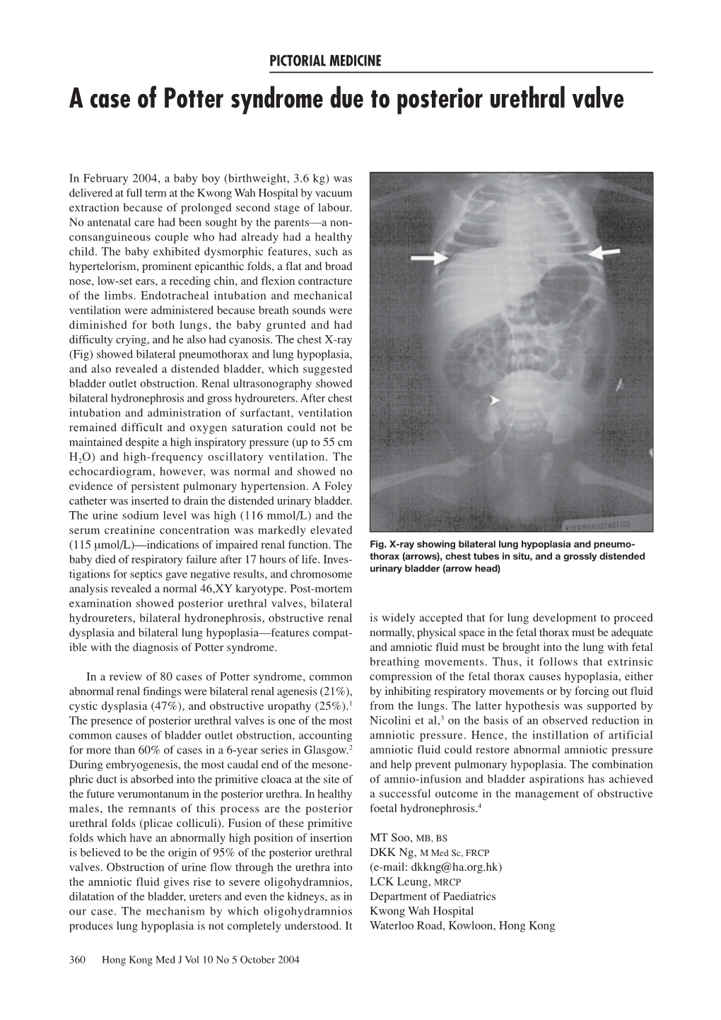 A Case of Potter Syndrome Due to Posterior Urethral Valve