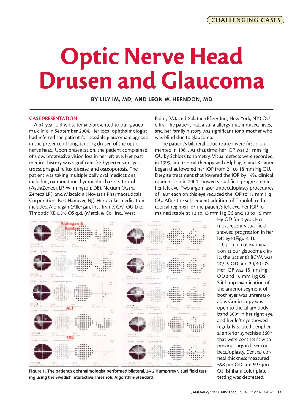 Optic Nerve Head Drusen and Glaucoma by LILY IM, MD, and LEON W