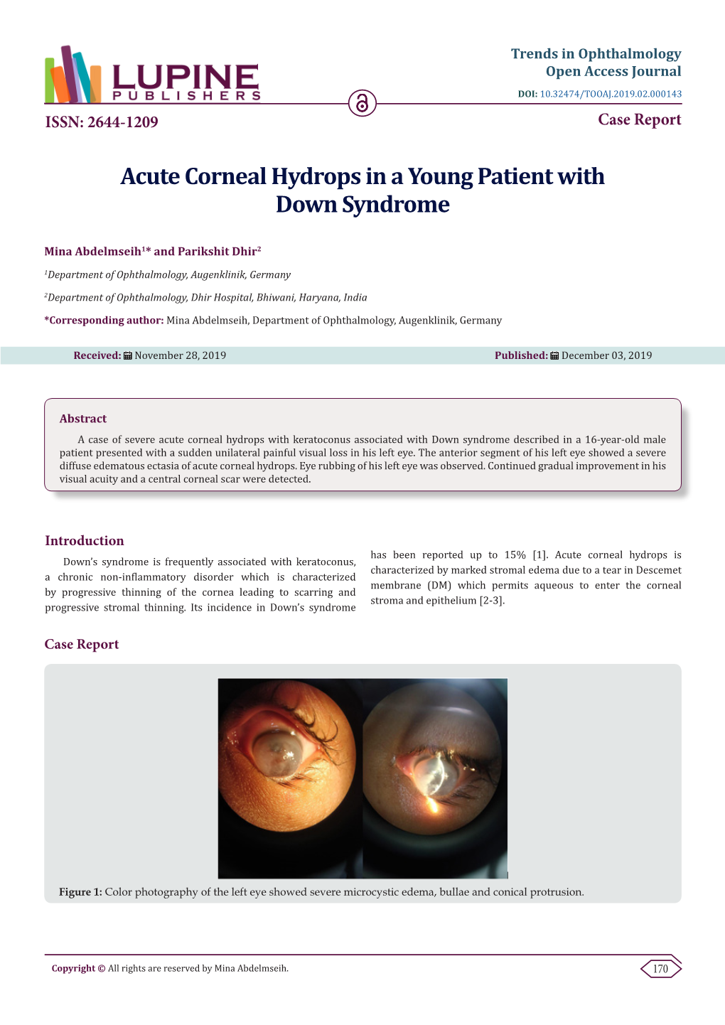Acute Corneal Hydrops in a Young Patient with Down Syndrome