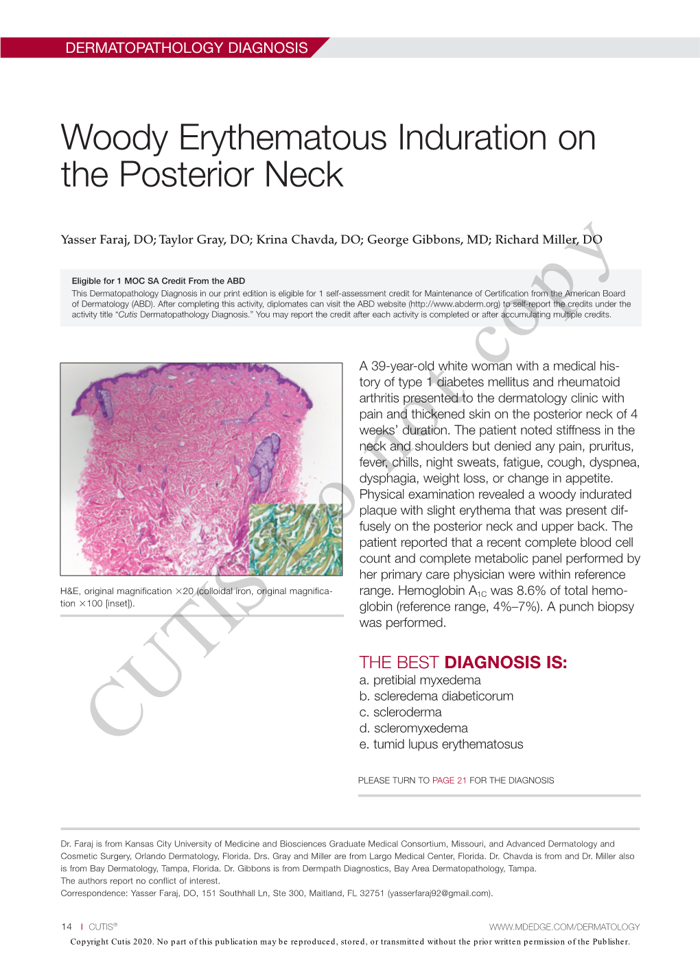 Woody Erythematous Induration on the Posterior Neck