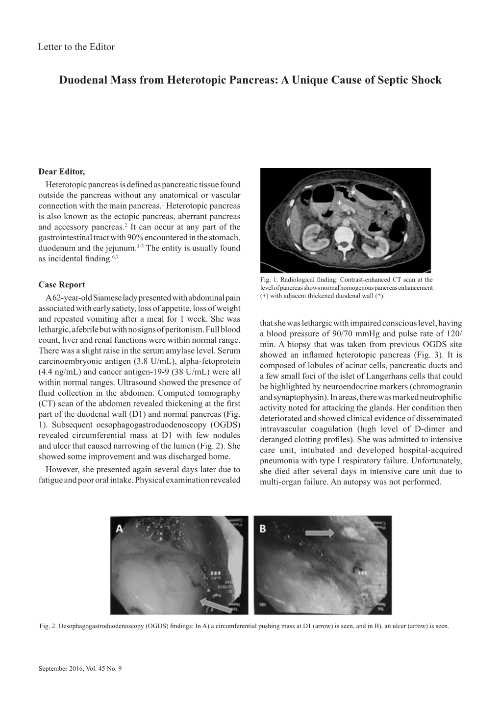 Duodenal Mass from Heterotopic Pancreas: a Unique Cause of Septic Shock