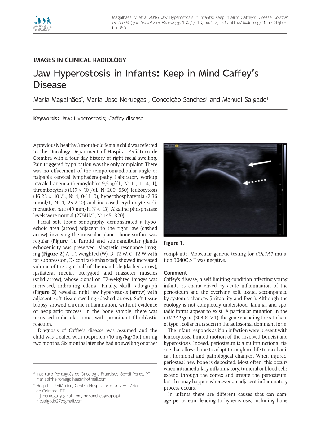 Jaw Hyperostosis in Infants: Keep in Mind Caffey's Disease