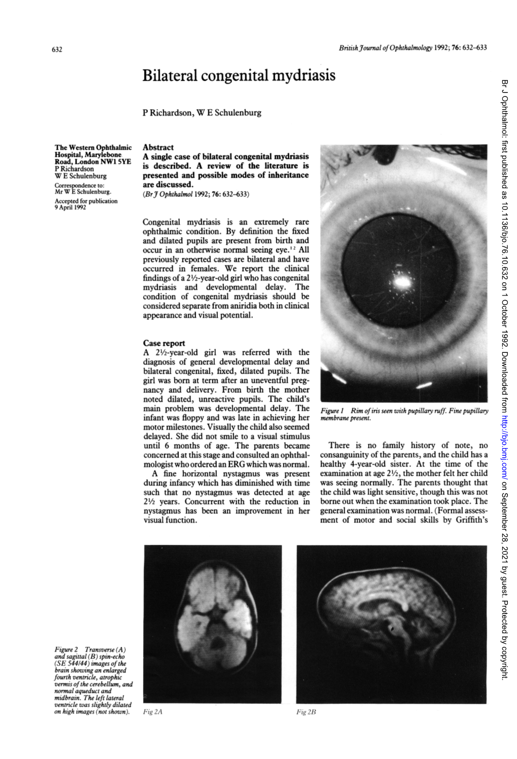 Bilateral Congenital Mydriasis Br J Ophthalmol: First Published As 10.1136/Bjo.76.10.632 on 1 October 1992