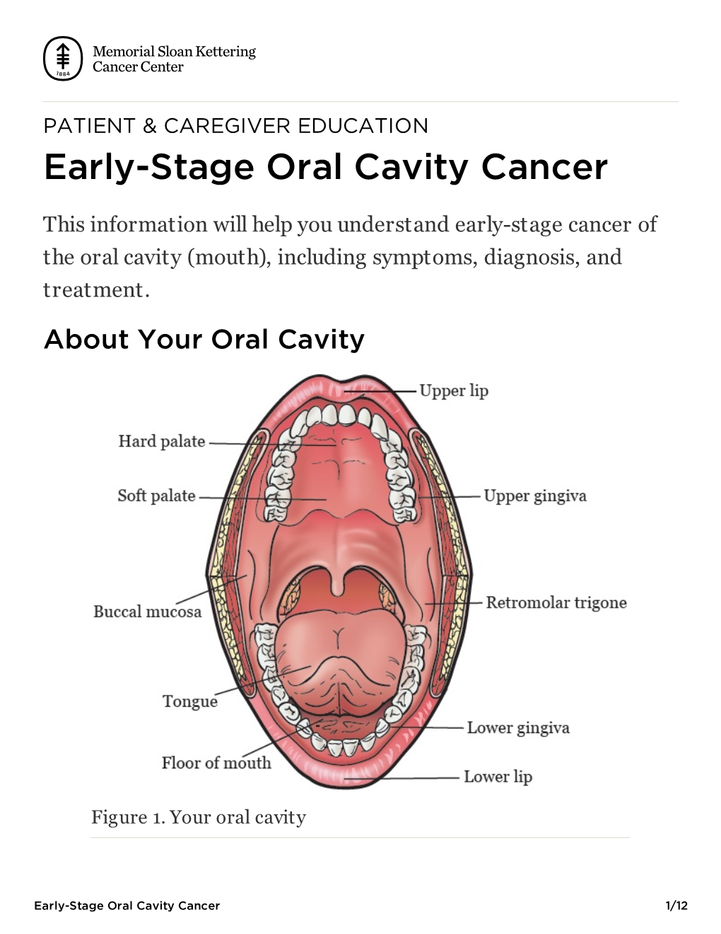 Early-Stage Oral Cavity Cancer
