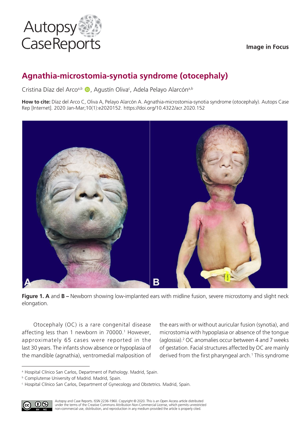 Agnathia-Microstomia-Synotia Syndrome (Otocephaly)