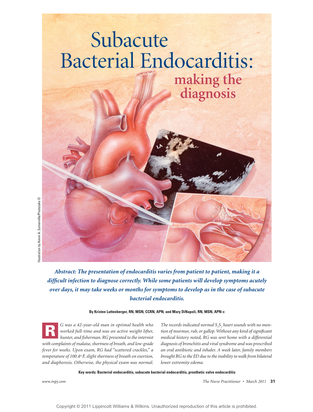 Subacute Bacterial Endocarditis: Making the Diagnosis Illustration by Kevin A