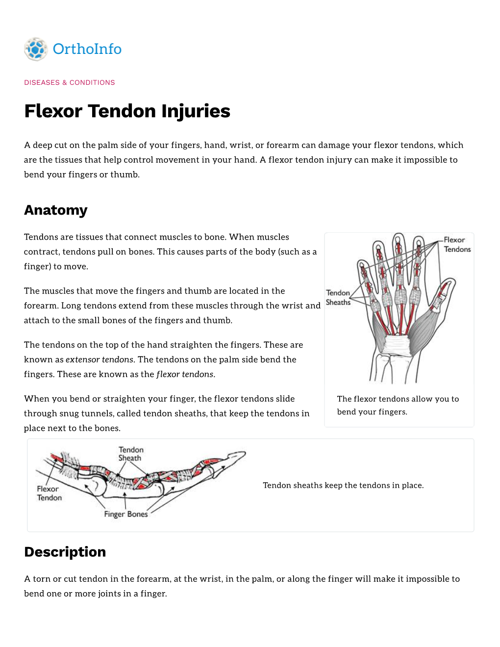 Flexor Tendon Injuries