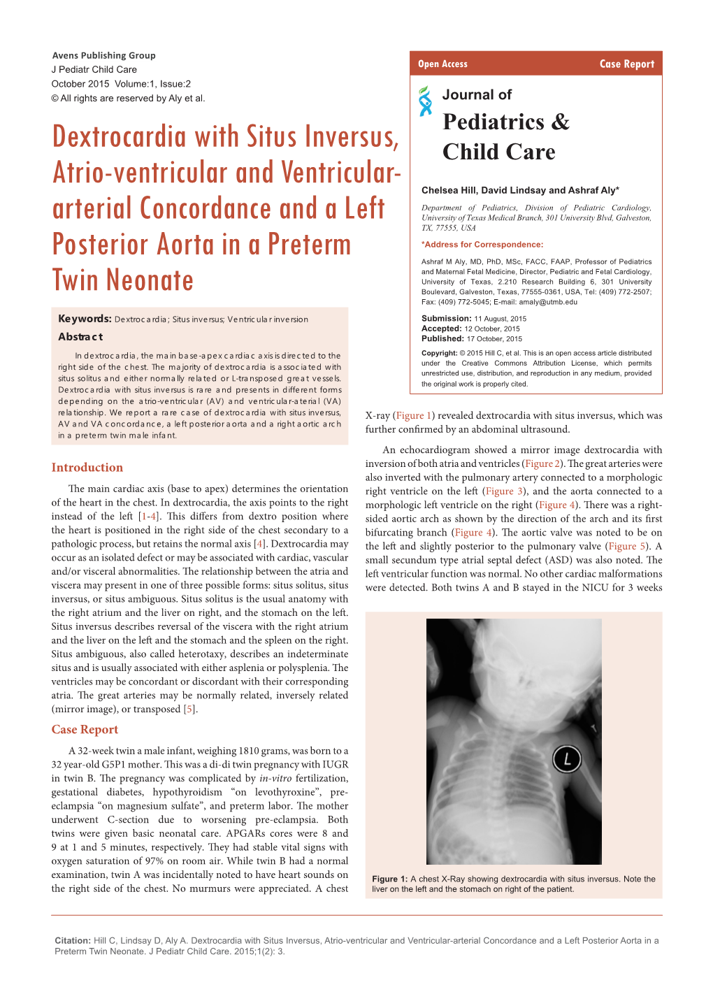 Dextrocardia with Situs Inversus, Atrio-Ventricular and Ventricular-Arterial Concordance and a Left Posterior Aorta in a Preterm Twin Neonate