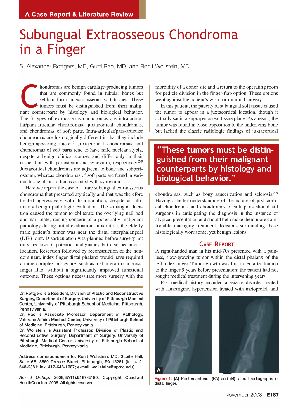 Subungual Extraosseous Chondroma in a Finger