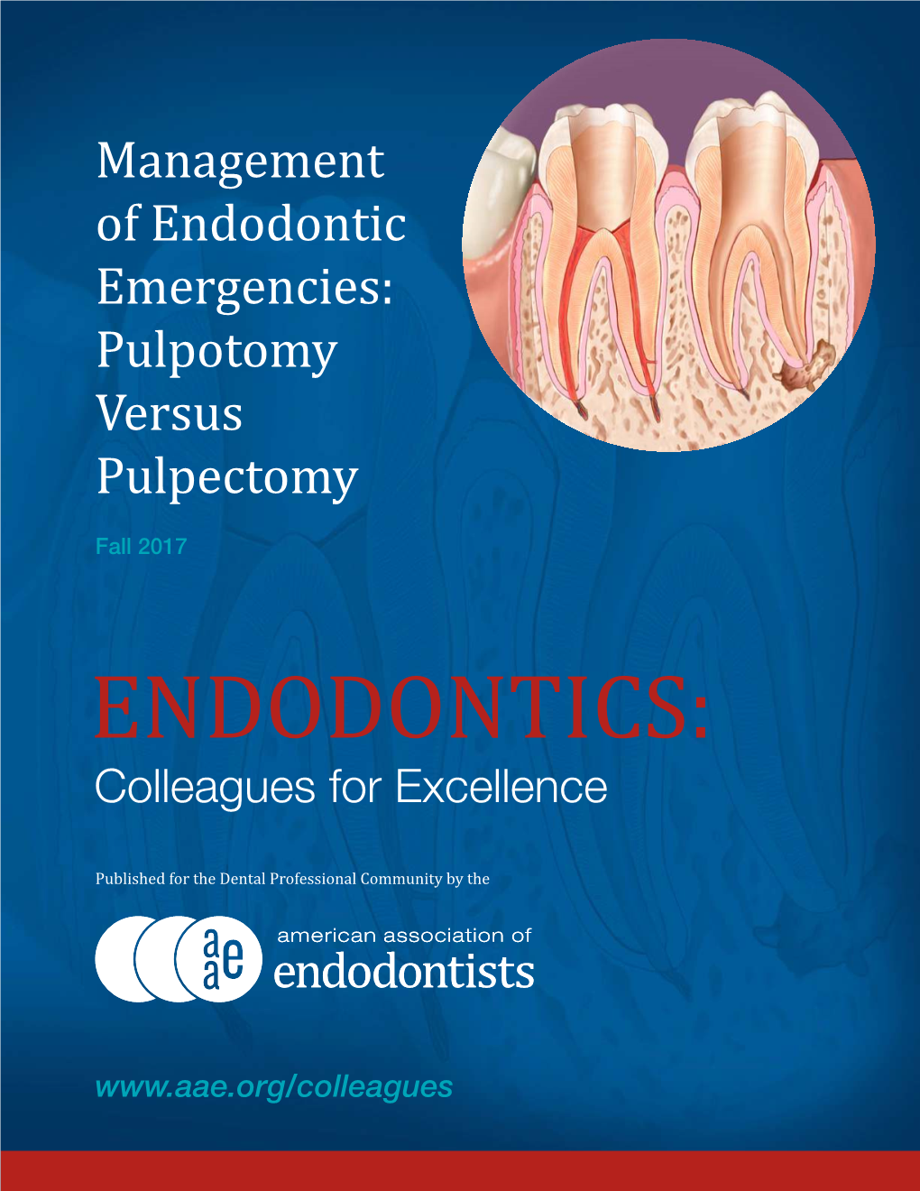 Management of Endodontic Emergencies: Pulpotomy Versus Pulpectomy