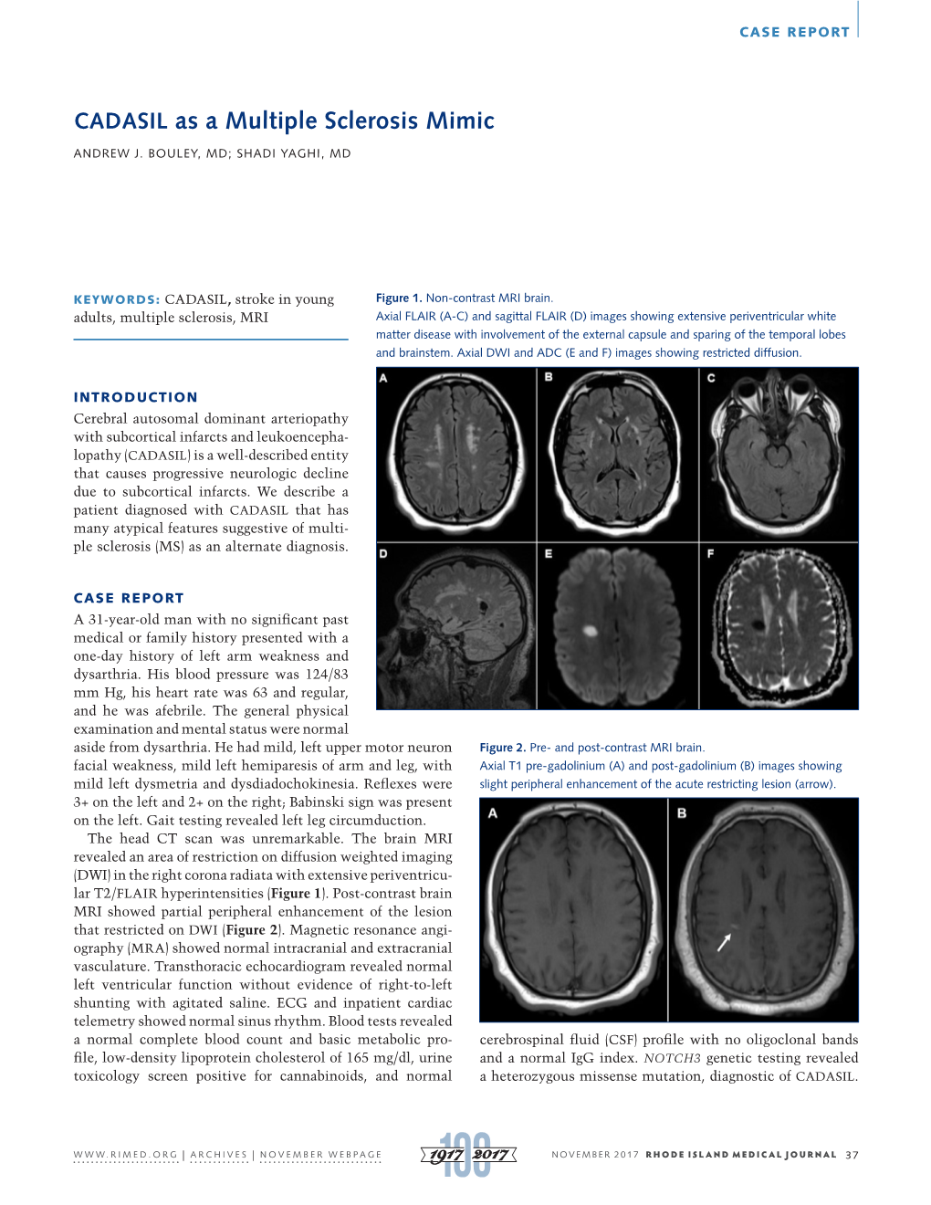 CADASIL As a Multiple Sclerosis Mimic