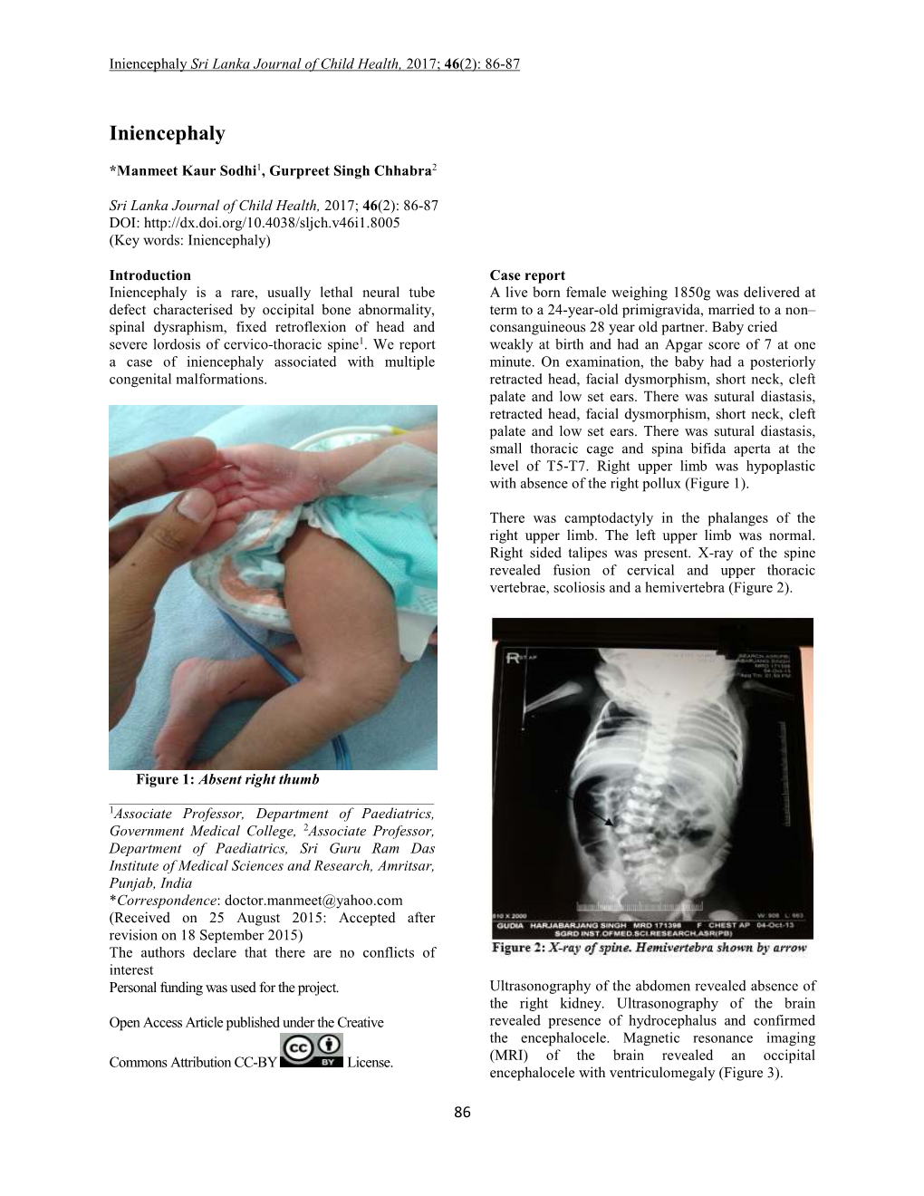 Iniencephaly Sri Lanka Journal of Child Health, 2017; 46 (2): 86-87