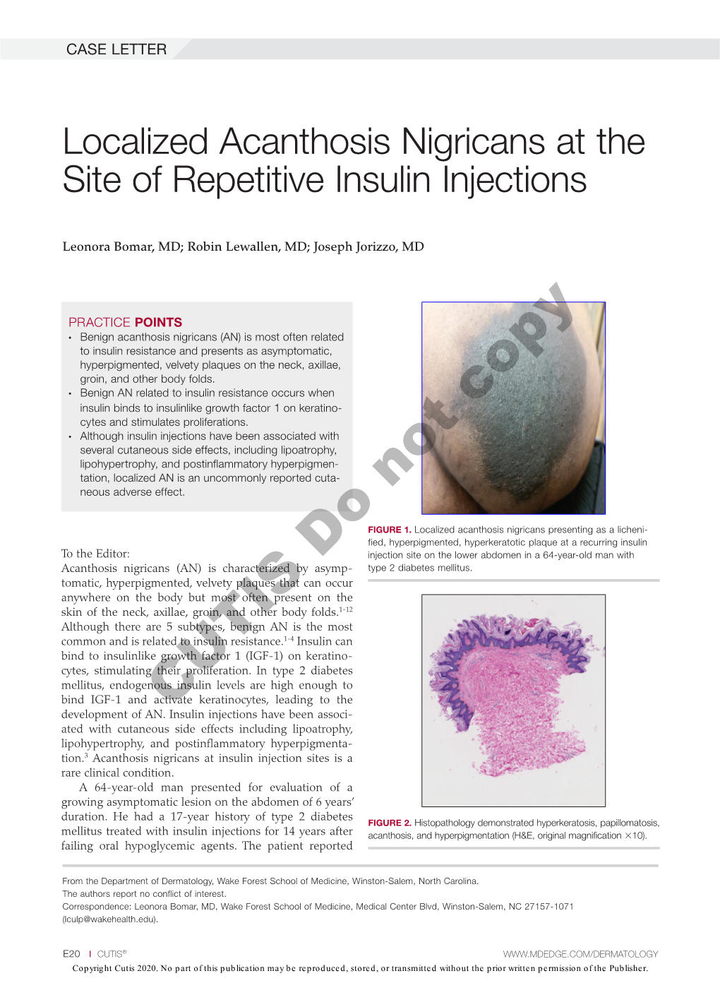 Localized Acanthosis Nigricans at the Site of Repetitive Insulin Injections