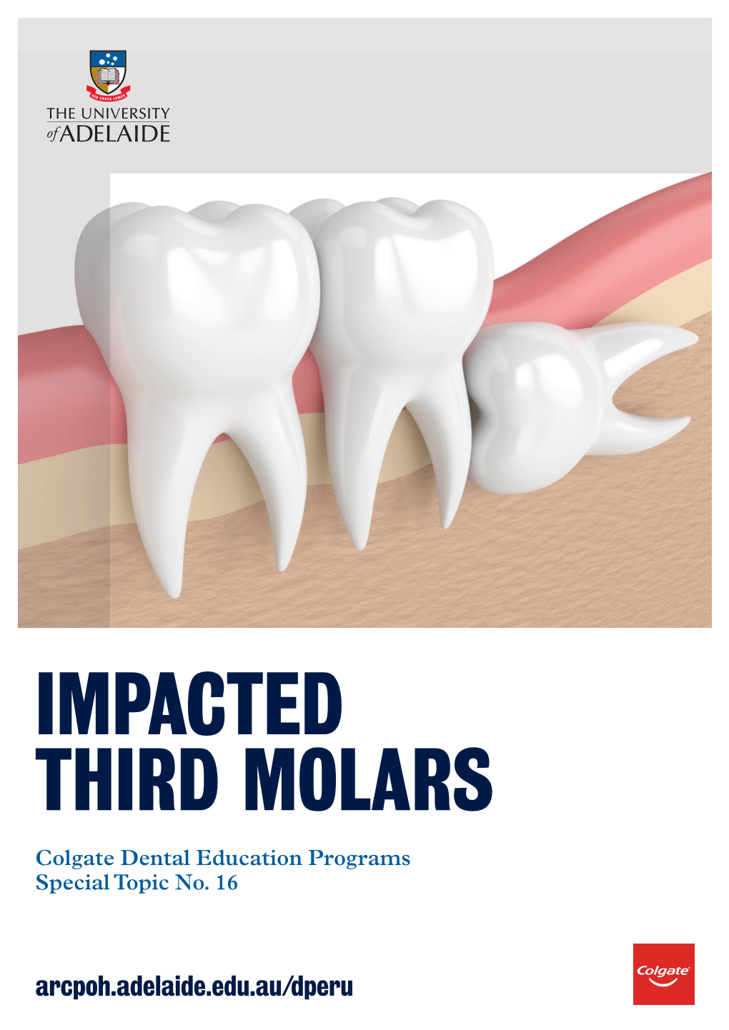 IMPACTED THIRD MOLARS Colgate Dental Education Programs Special Topic No
