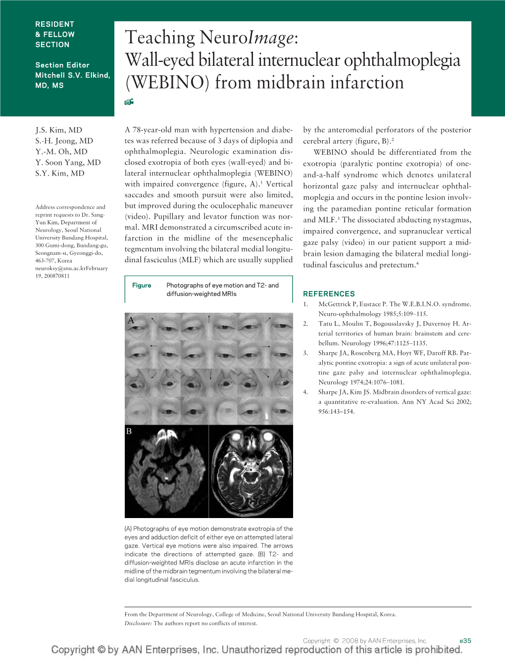 Wall-Eyed Bilateral Internuclear Ophthalmoplegia Mitchell S.V