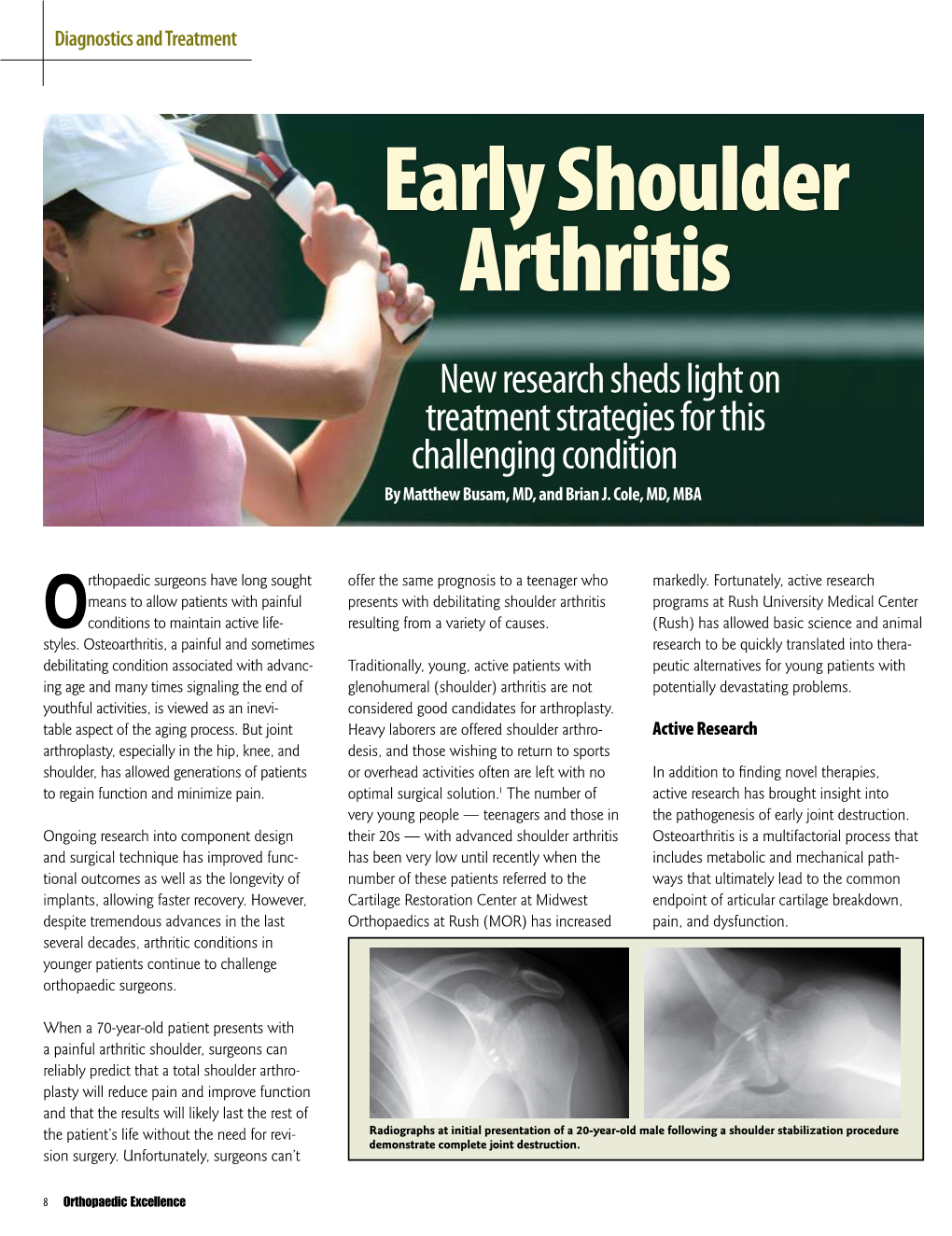 Early Shoulder Arthritis