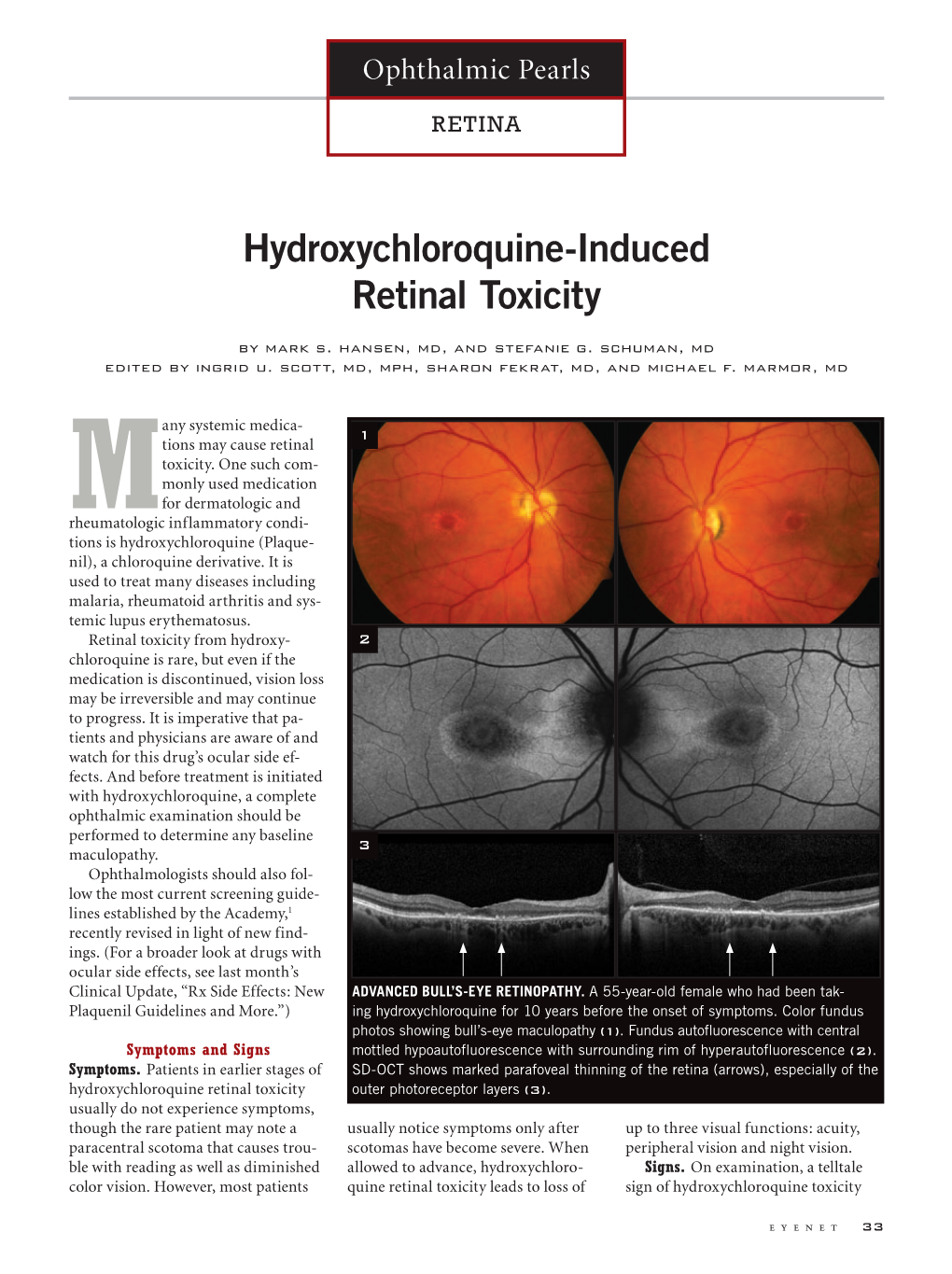 Hydroxychloroquine-Induced Retinal Toxicity