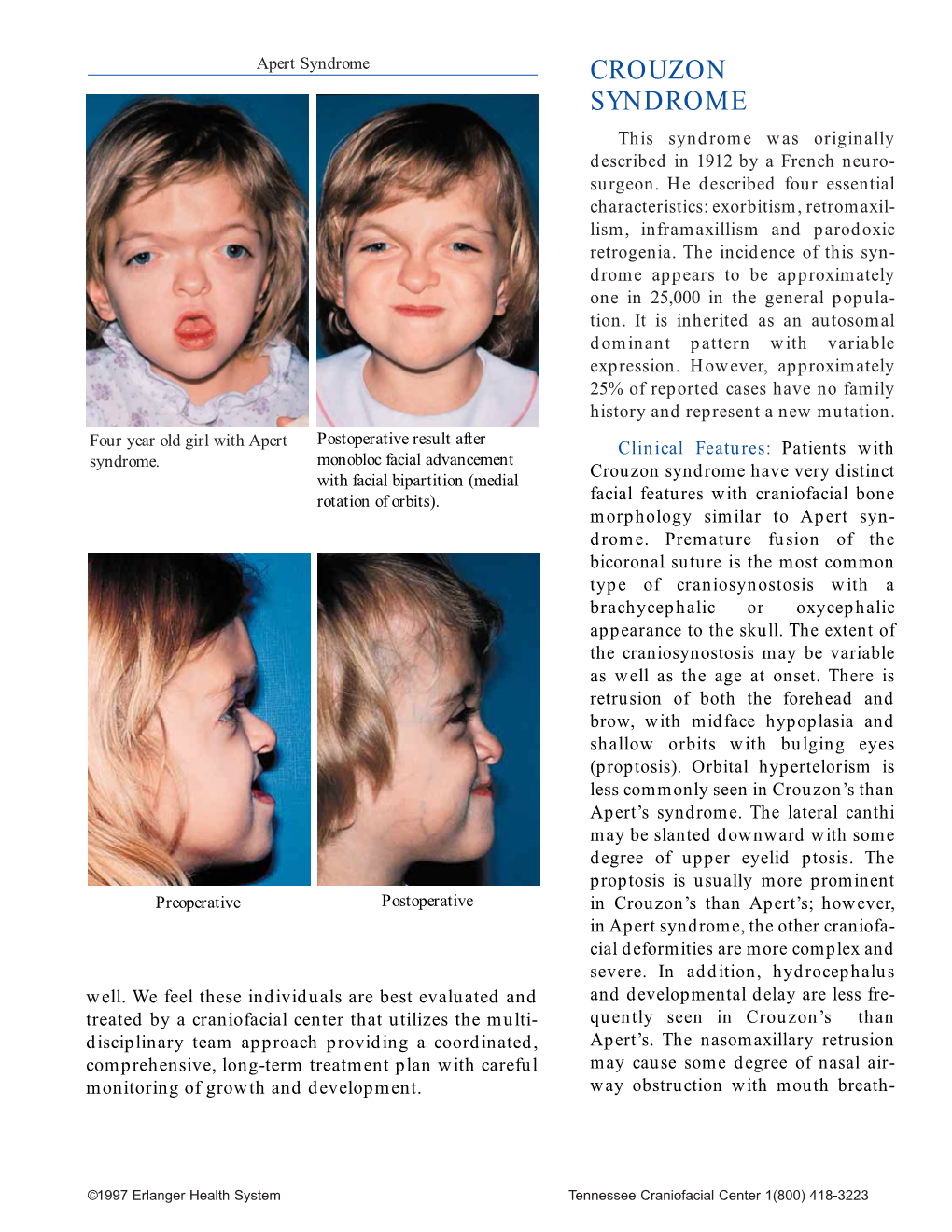 CROUZON SYNDROME This Syndrome Was Originally Described in 1912 by a French Neuro- Surgeon