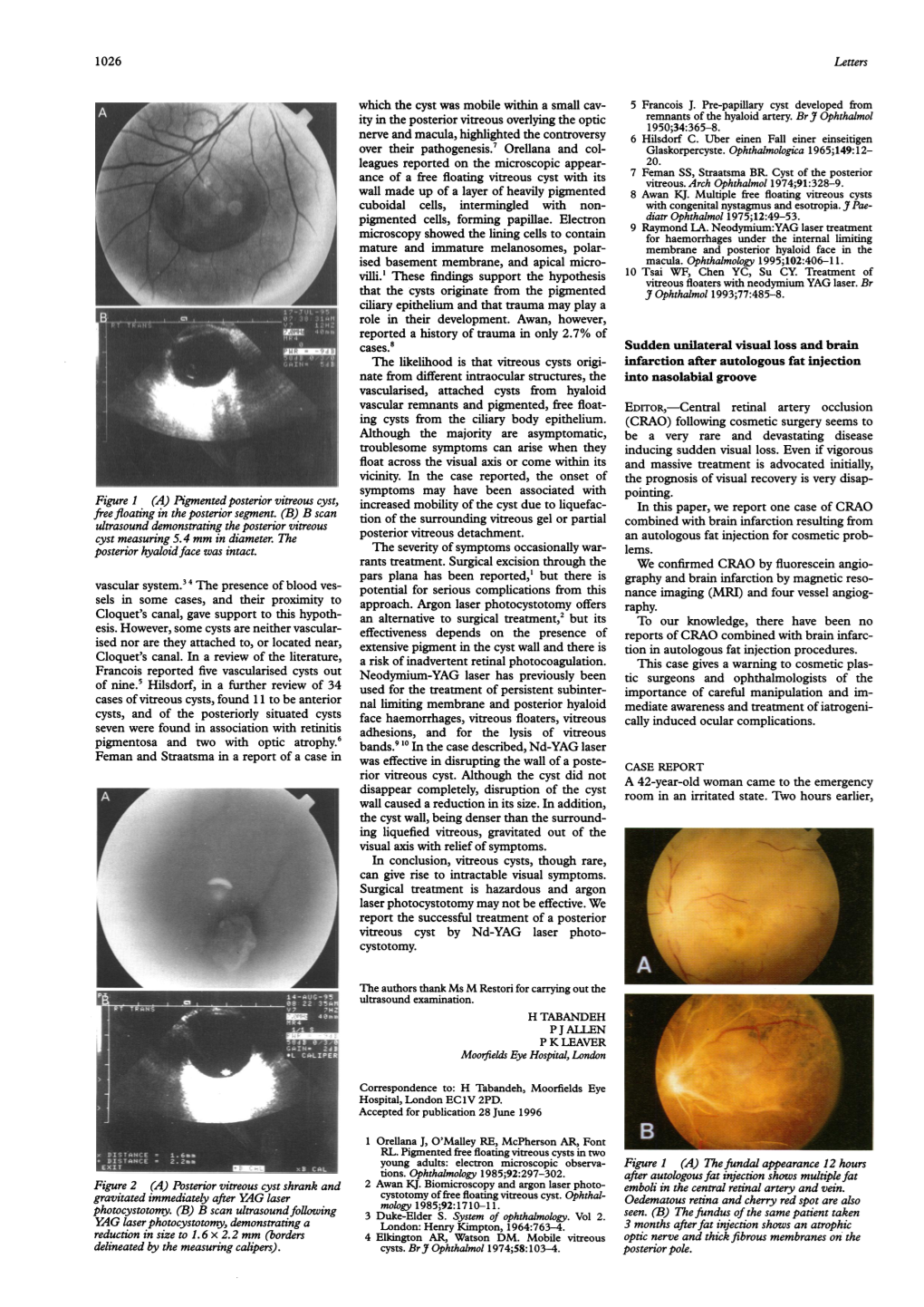 Figure 1 (A) Pigmentedposterior Vitreous Cyst, Ultrasound