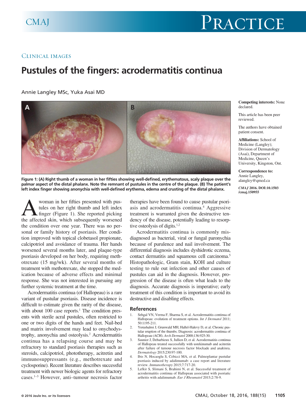 Pustules of the Fingers: Acrodermatitis Continua