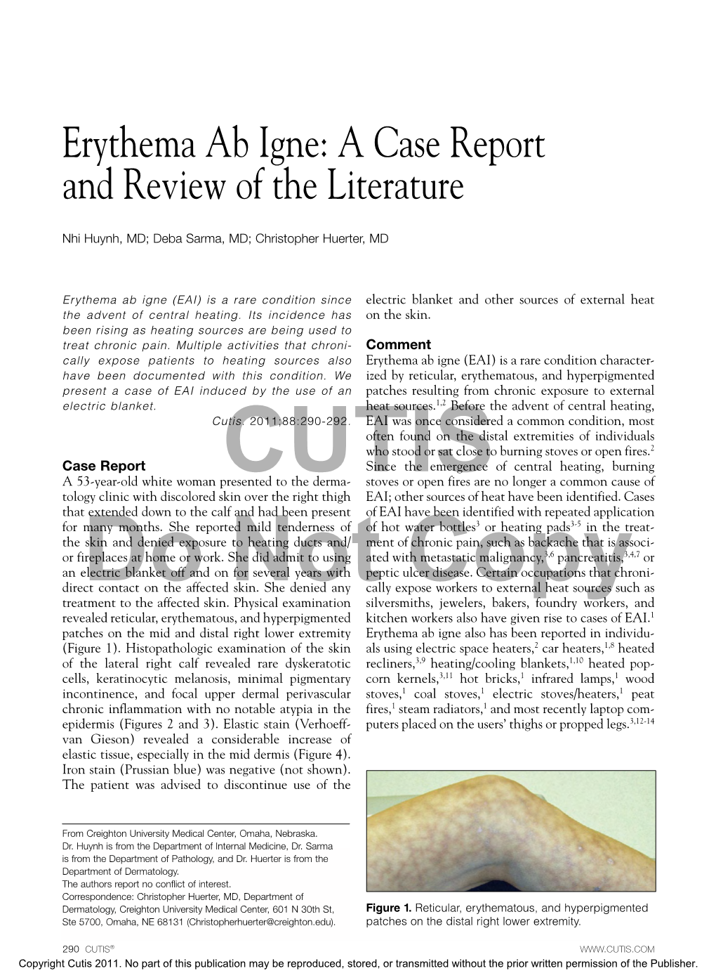 Erythema Ab Igne: a Case Report and Review of the Literature
