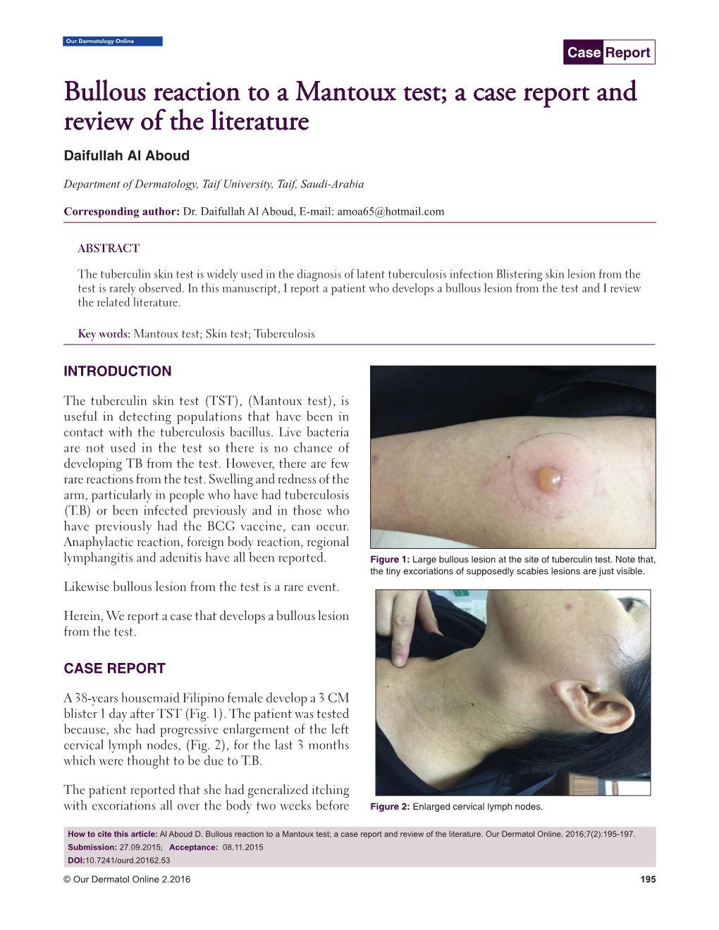Bullous Reaction to a Mantoux Test; a Case Report and Review of the Literature