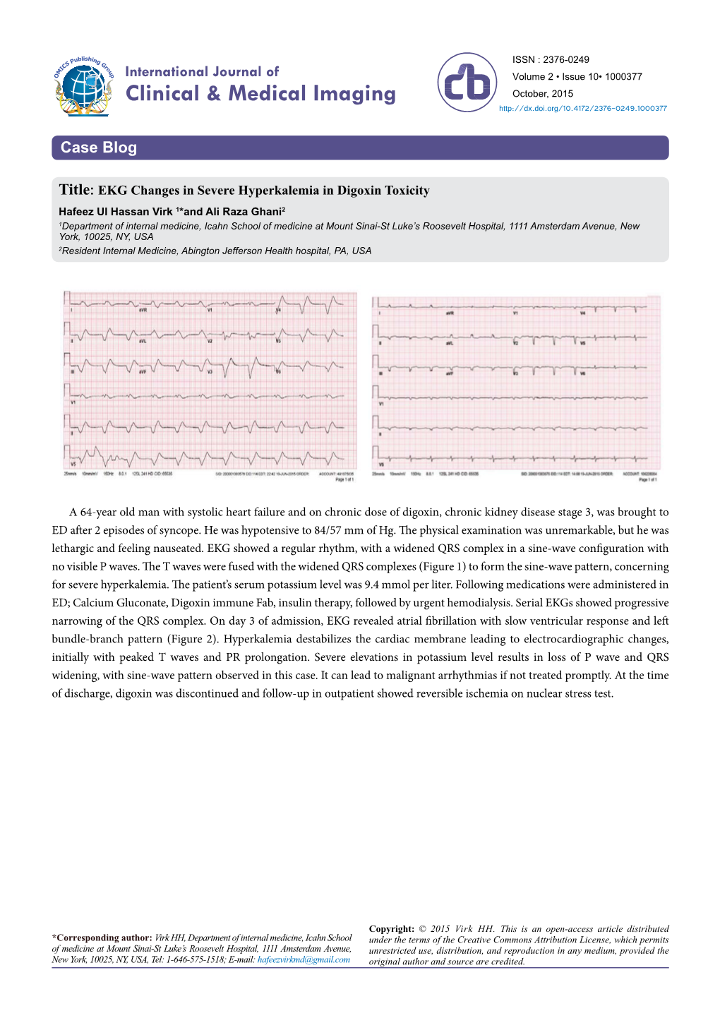 EKG Changes in Severe Hyperkalemia in Digoxin Toxicity