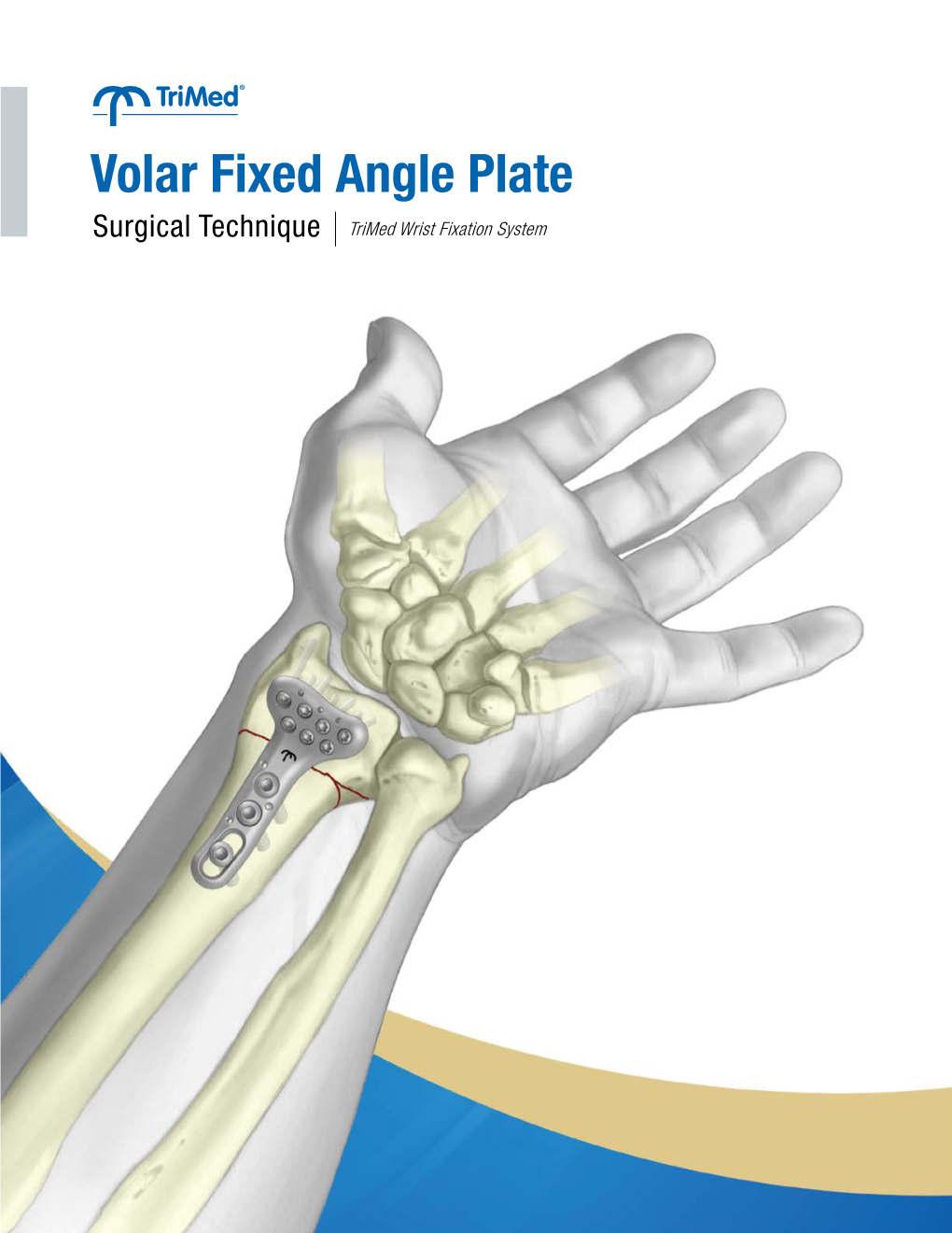 Volar Fixed Angle Plate Surgical Technique Trimed Wrist Fixation System Volar Fixed Angle Plate