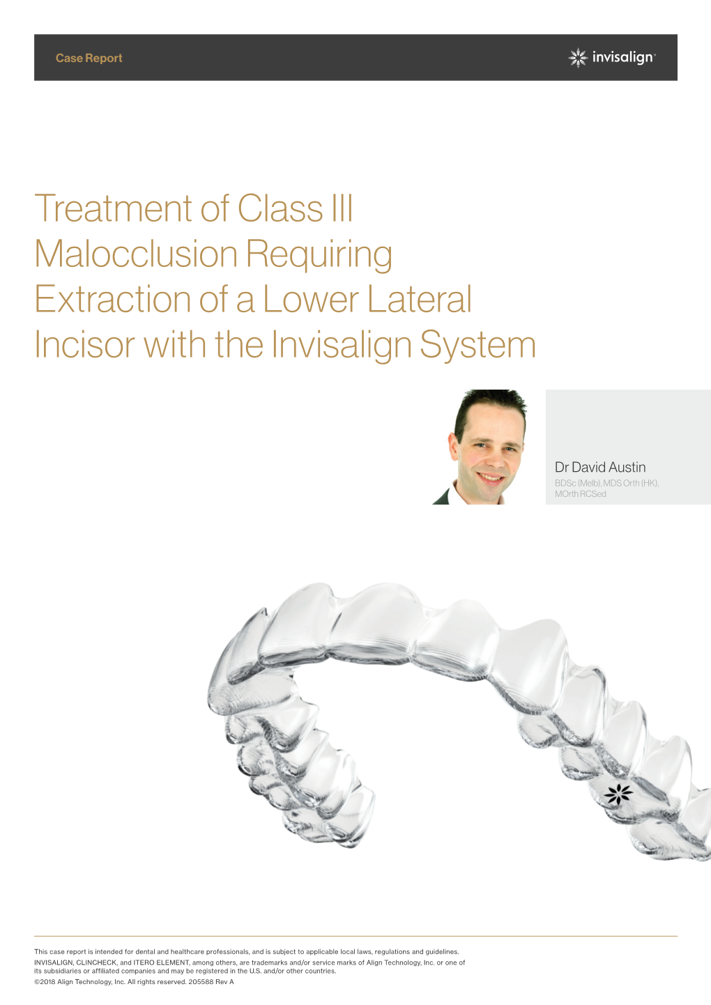 Treatment of Class III Malocclusion Requiring Extraction of a Lower Lateral Incisor with the Invisalign System