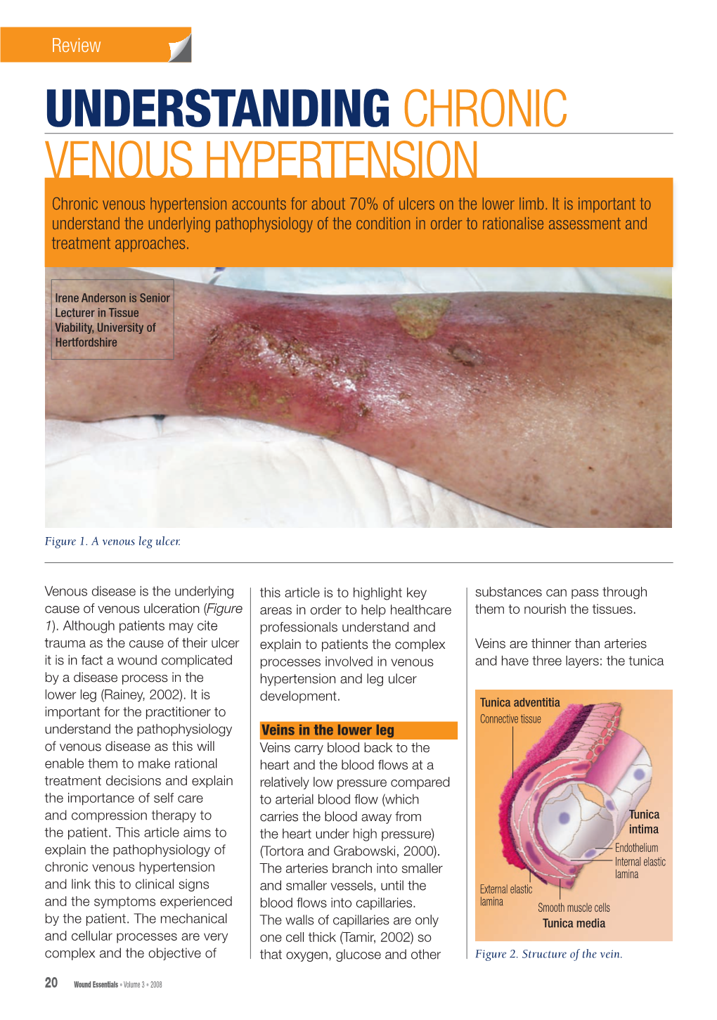 UNDERSTANDING CHRONIC VENOUS HYPERTENSION Chronic Venous Hypertension Accounts for About 70% of Ulcers on the Lower Limb