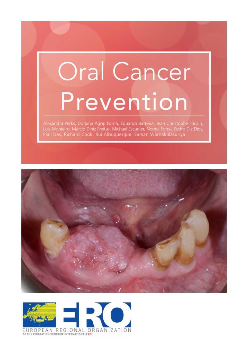 Oral Cancer Prevention Levels