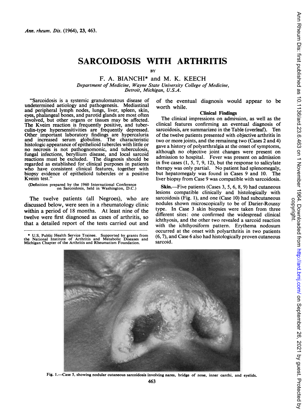 Sarcoidosis with Arthritis by F